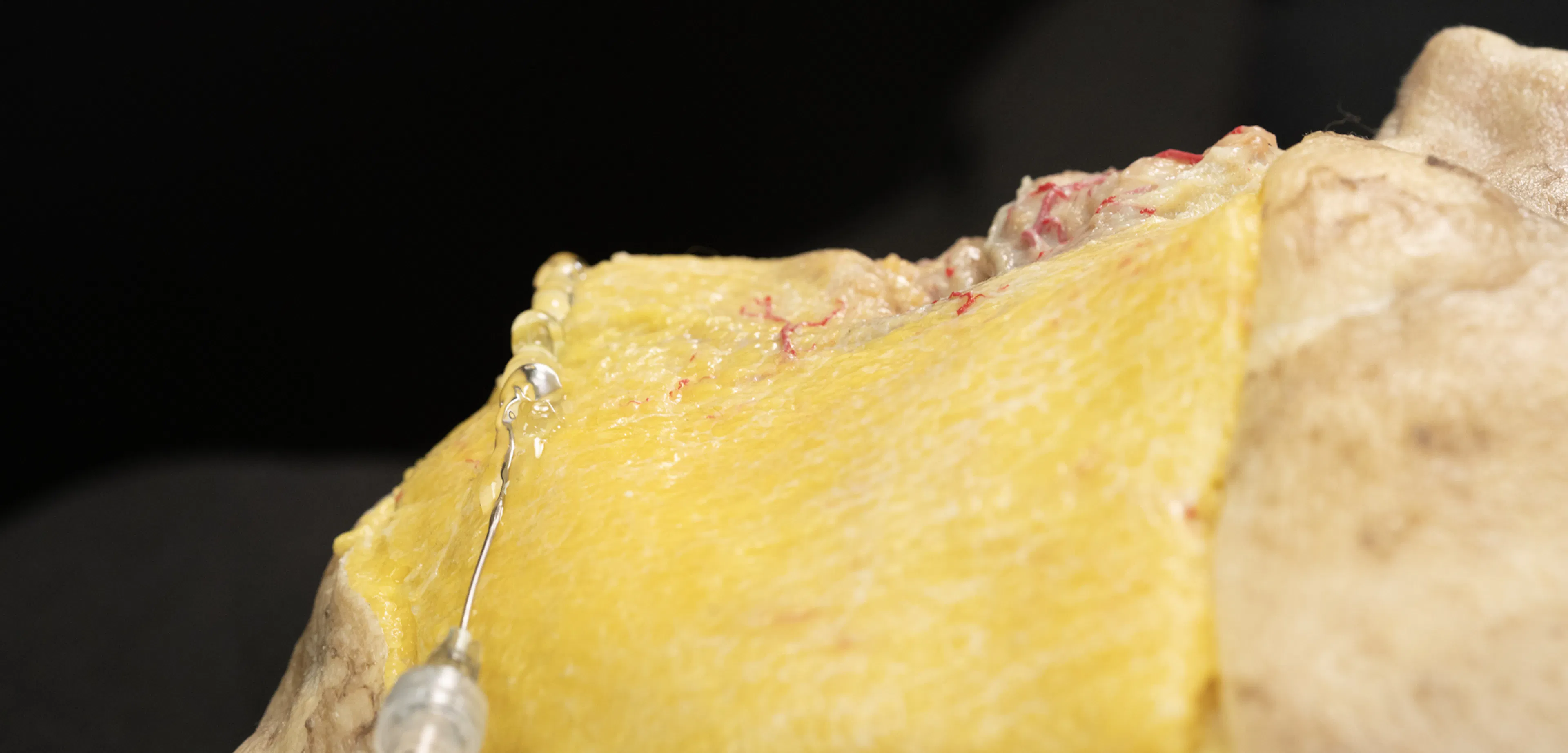 Biostimulator Treatments of the Jawline: Superficial Cannula Technique