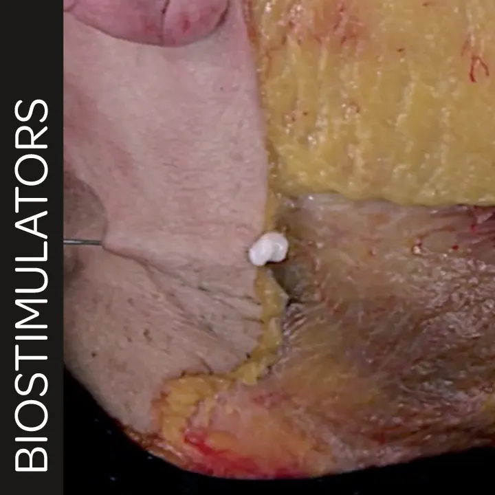 Biostimulator Treatments of the Neck: Superficial Cannula Technique