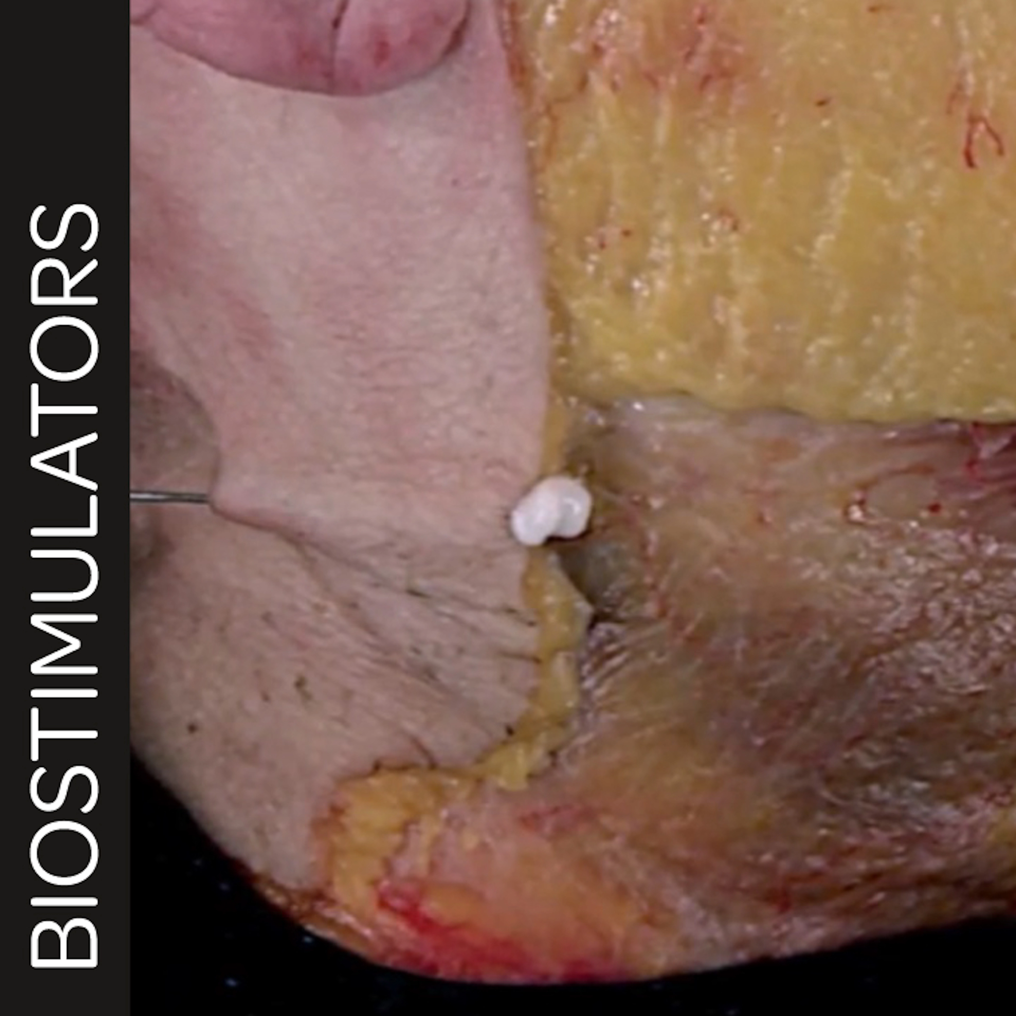 Biostimulator Treatments of the Neck: Superficial Cannula Technique