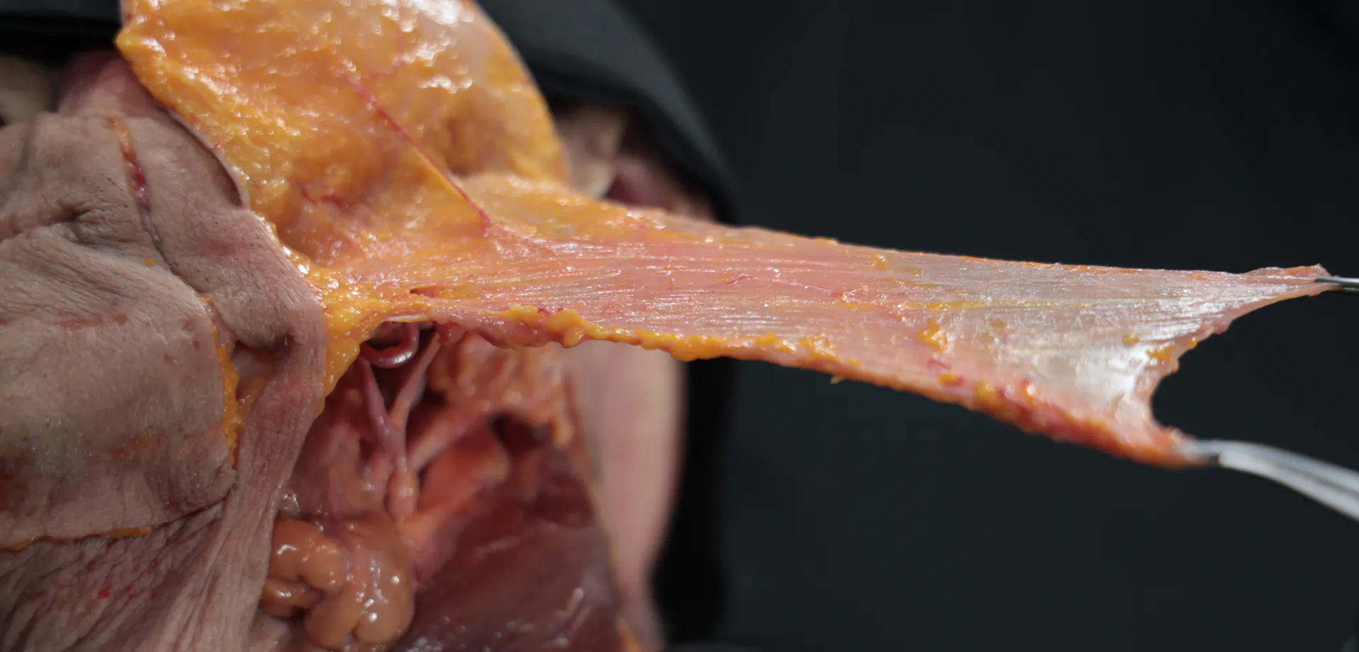 Biostimulator Treatments of the Neck: Superficial Cannula Technique