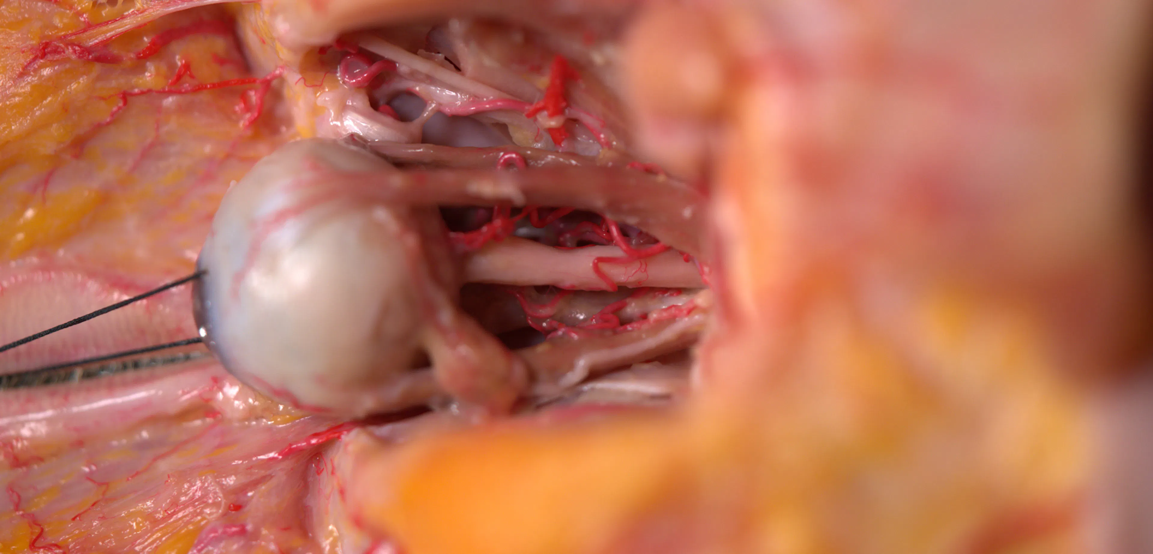 Extended Anatomic Review: The Ophthalmic Artery