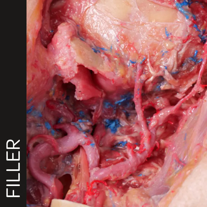 Extended Anatomic Review: The Maxillary Artery