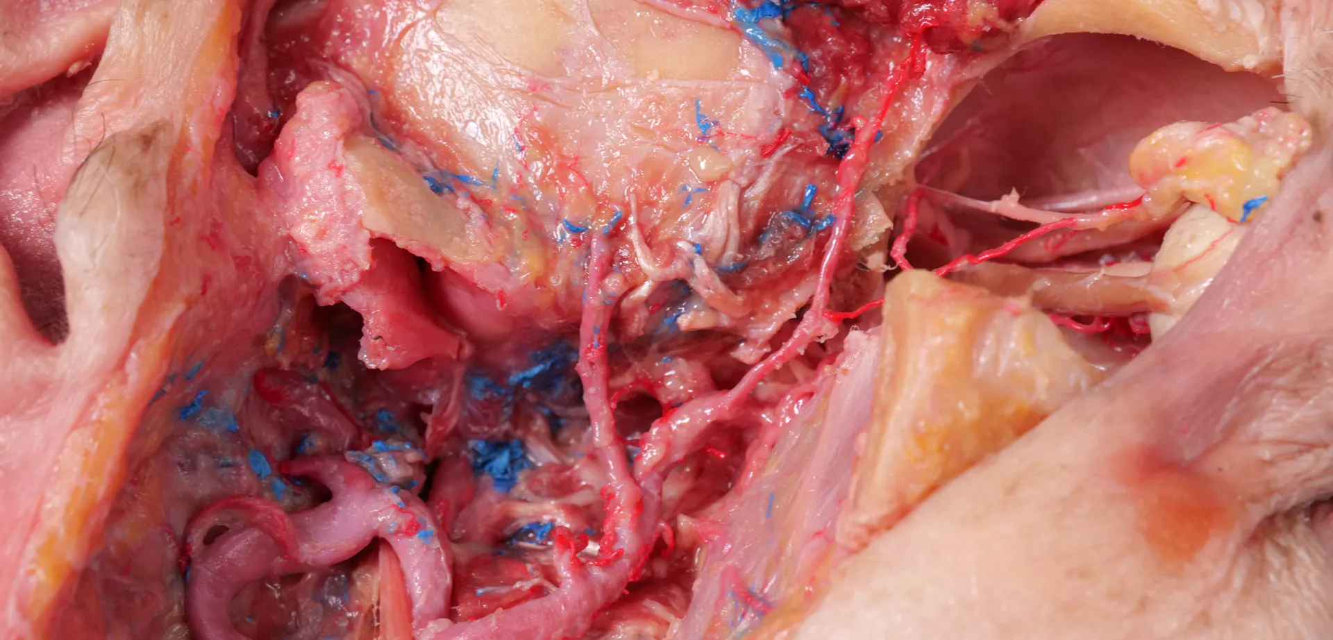 Extended Anatomic Review: The Maxillary Artery
