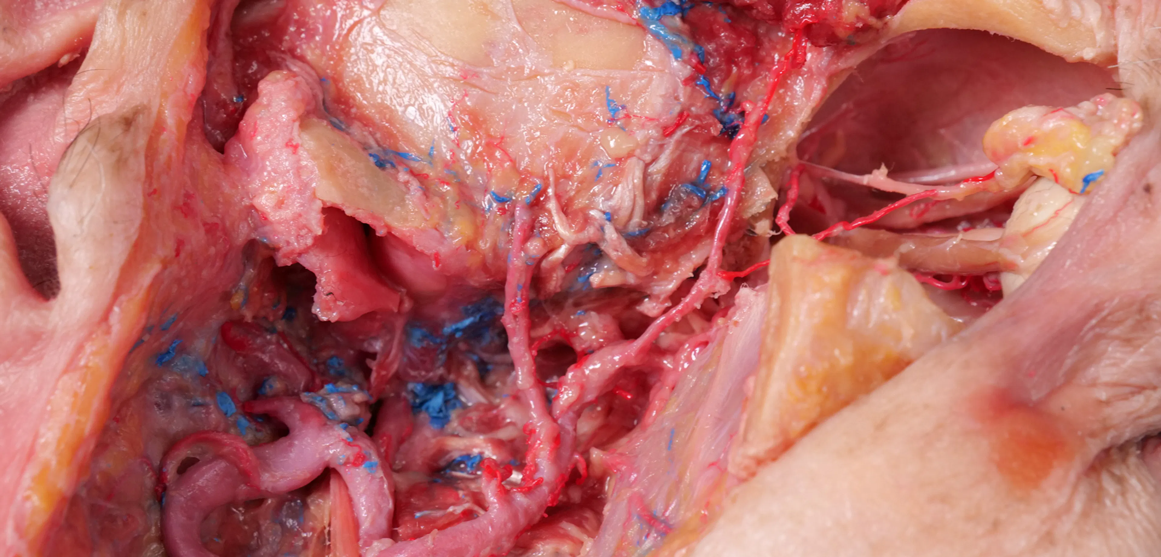 Extended Anatomic Review: The Maxillary Artery