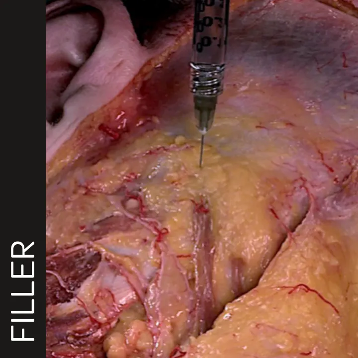 Zygomatic Arch Enhancement with Needle
