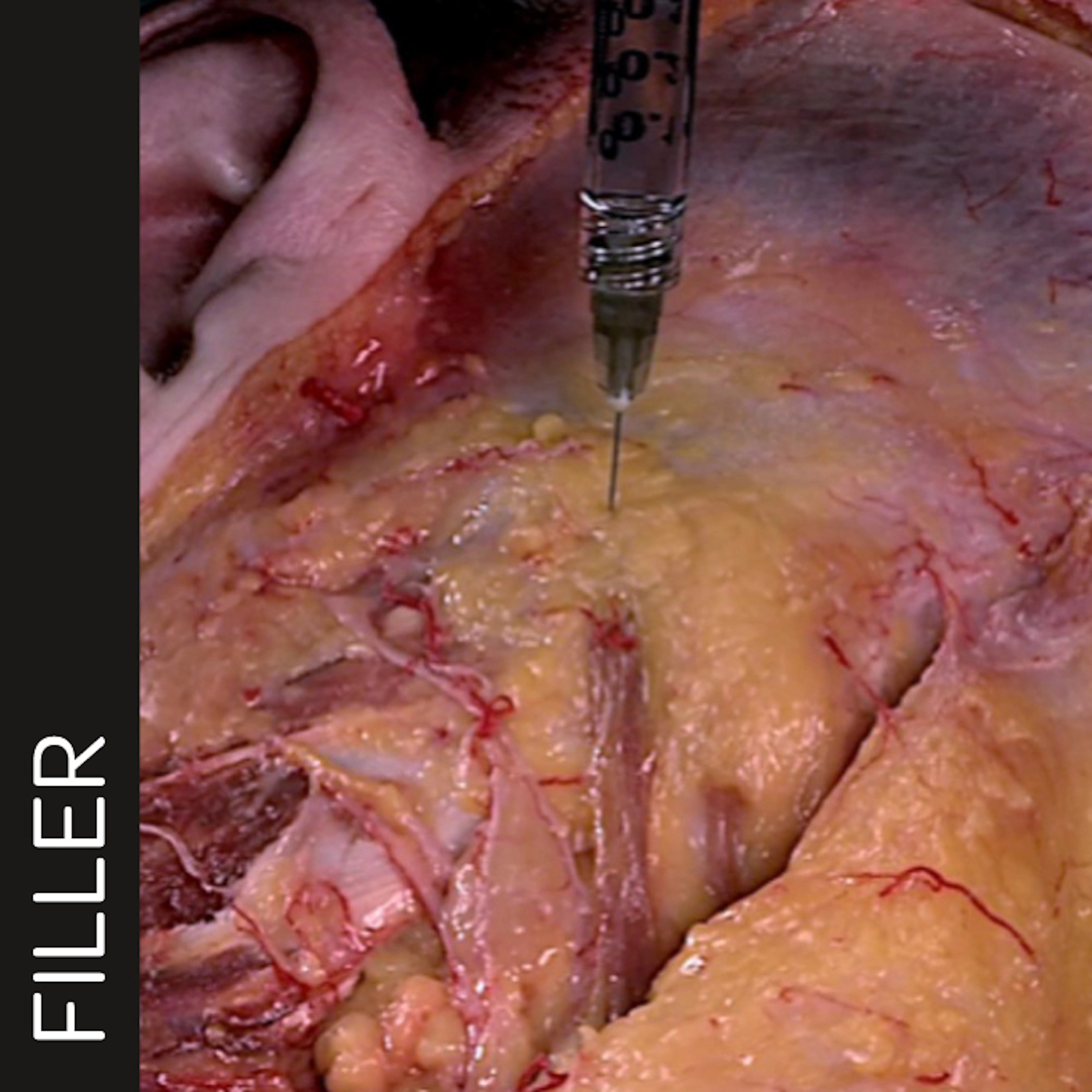 Zygomatic Arch Enhancement with Needle