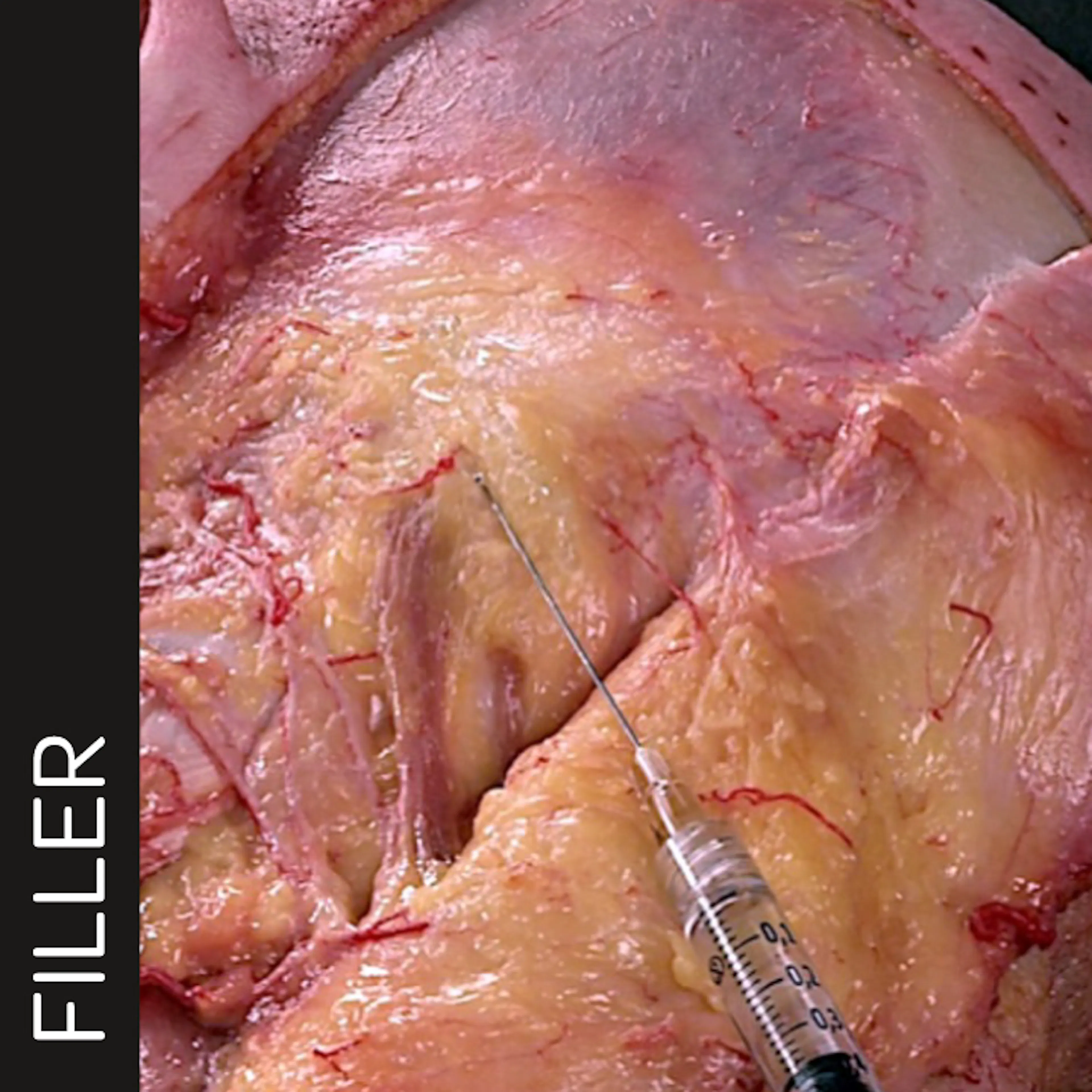 Deep Zygomatic Arch Enhancement with Cannula