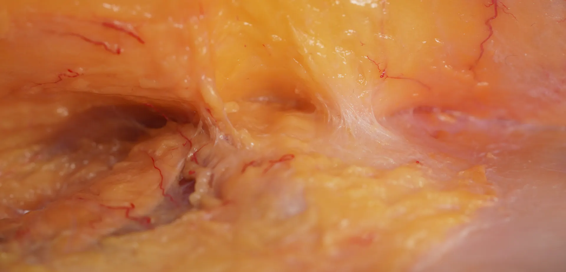 Deep Zygomatic Arch Enhancement with Cannula