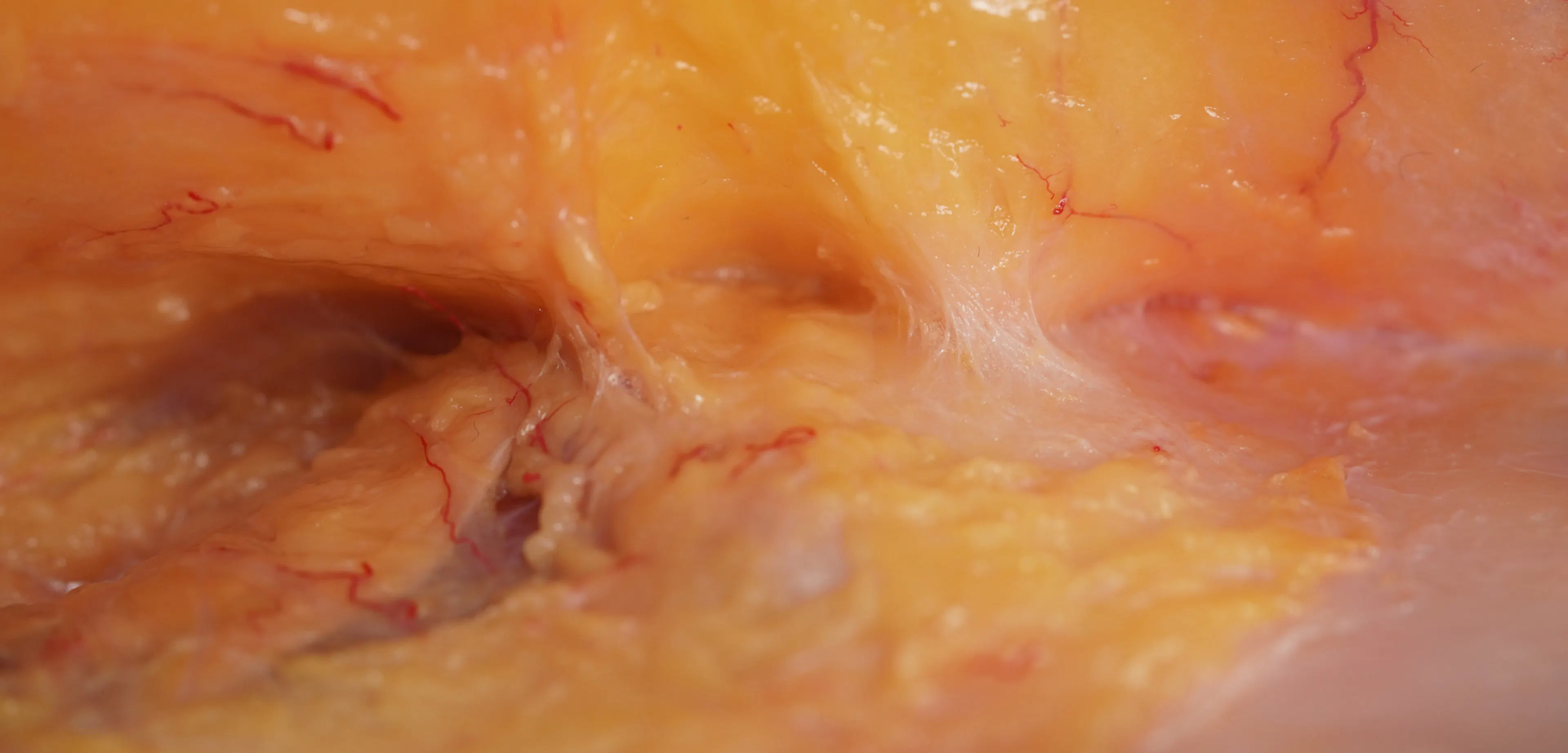 Deep Zygomatic Arch Enhancement with Cannula