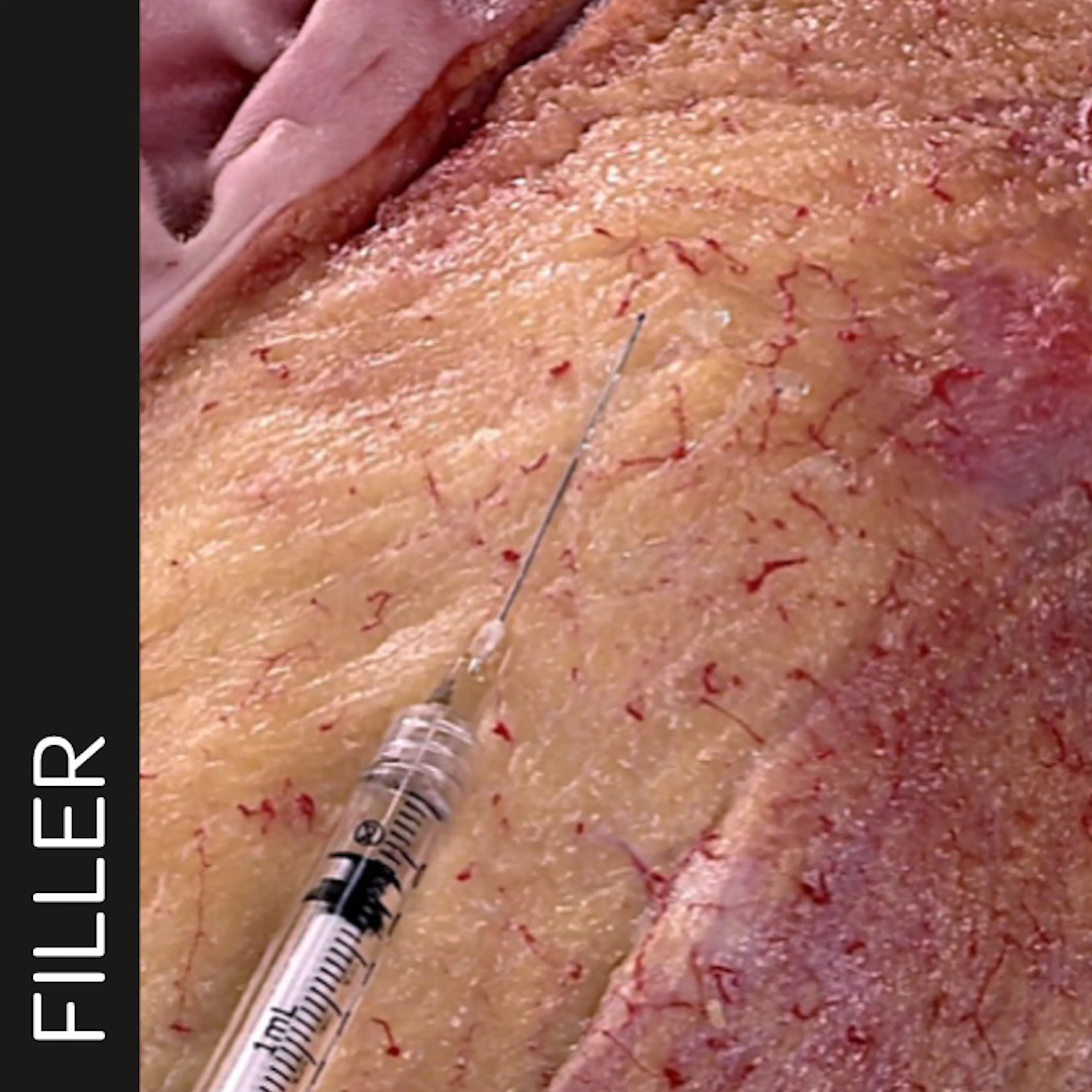 Superficial  Zygomatic Arch Enhancement with Cannula