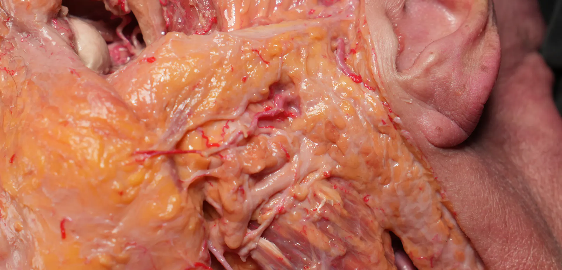 Superficial Zygomatic Arch Enhancement with Cannula