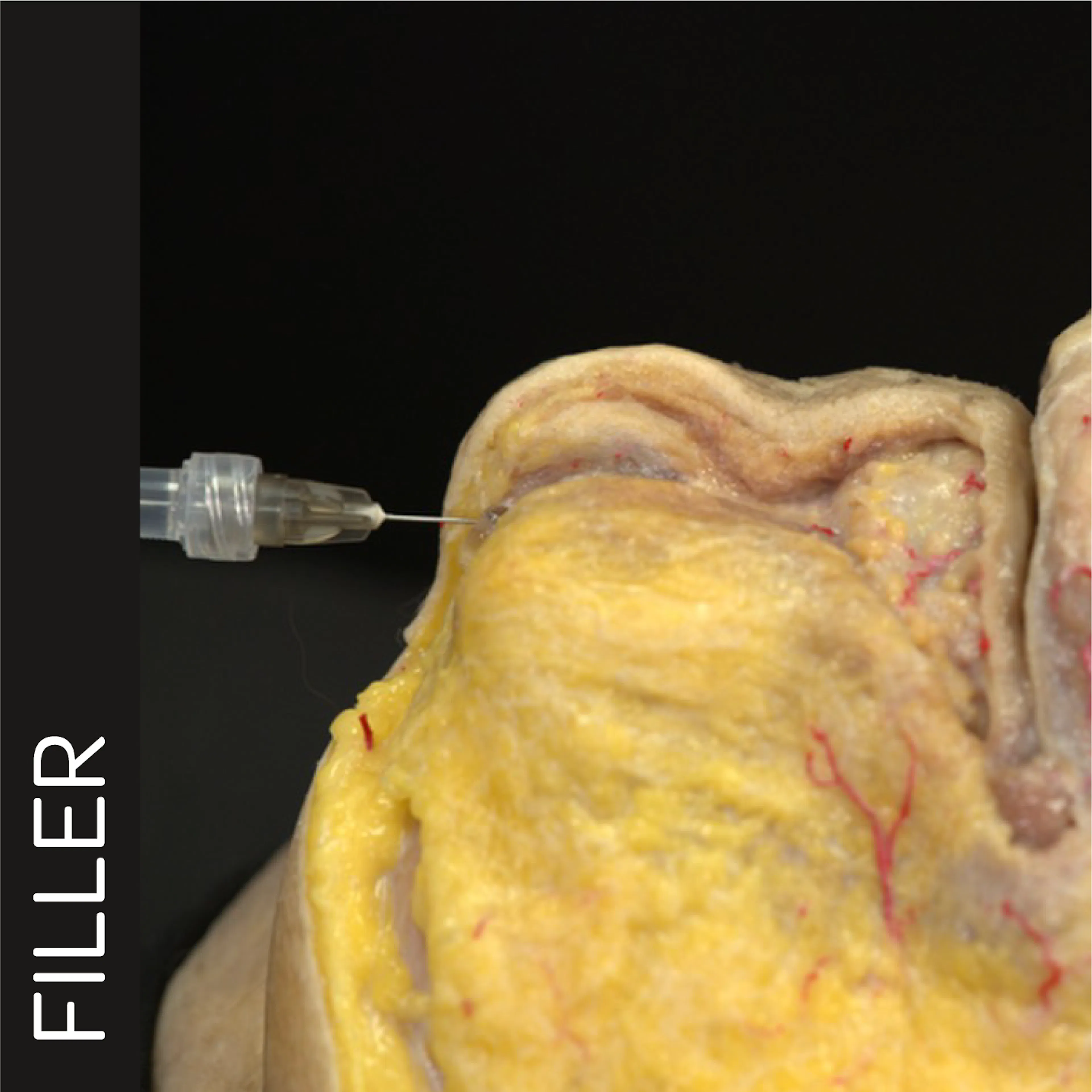 Chin Zone Treatment with Needle
