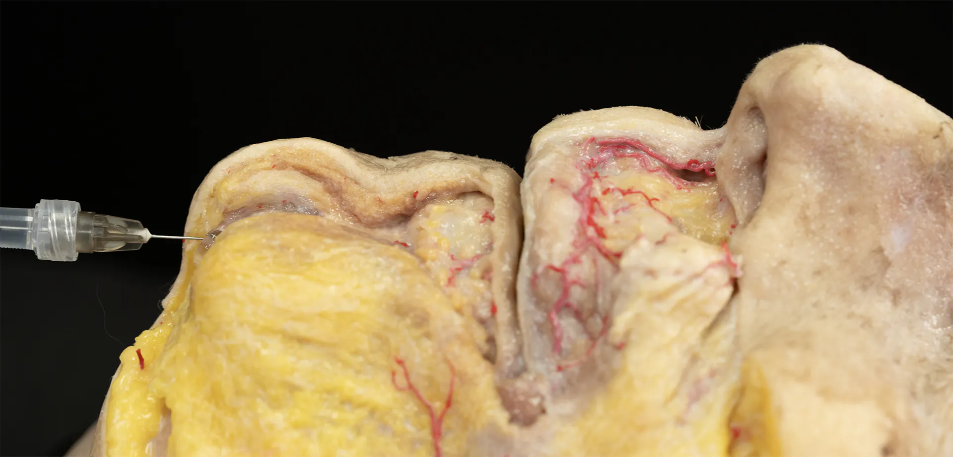 Chin Zone Treatment with Needle