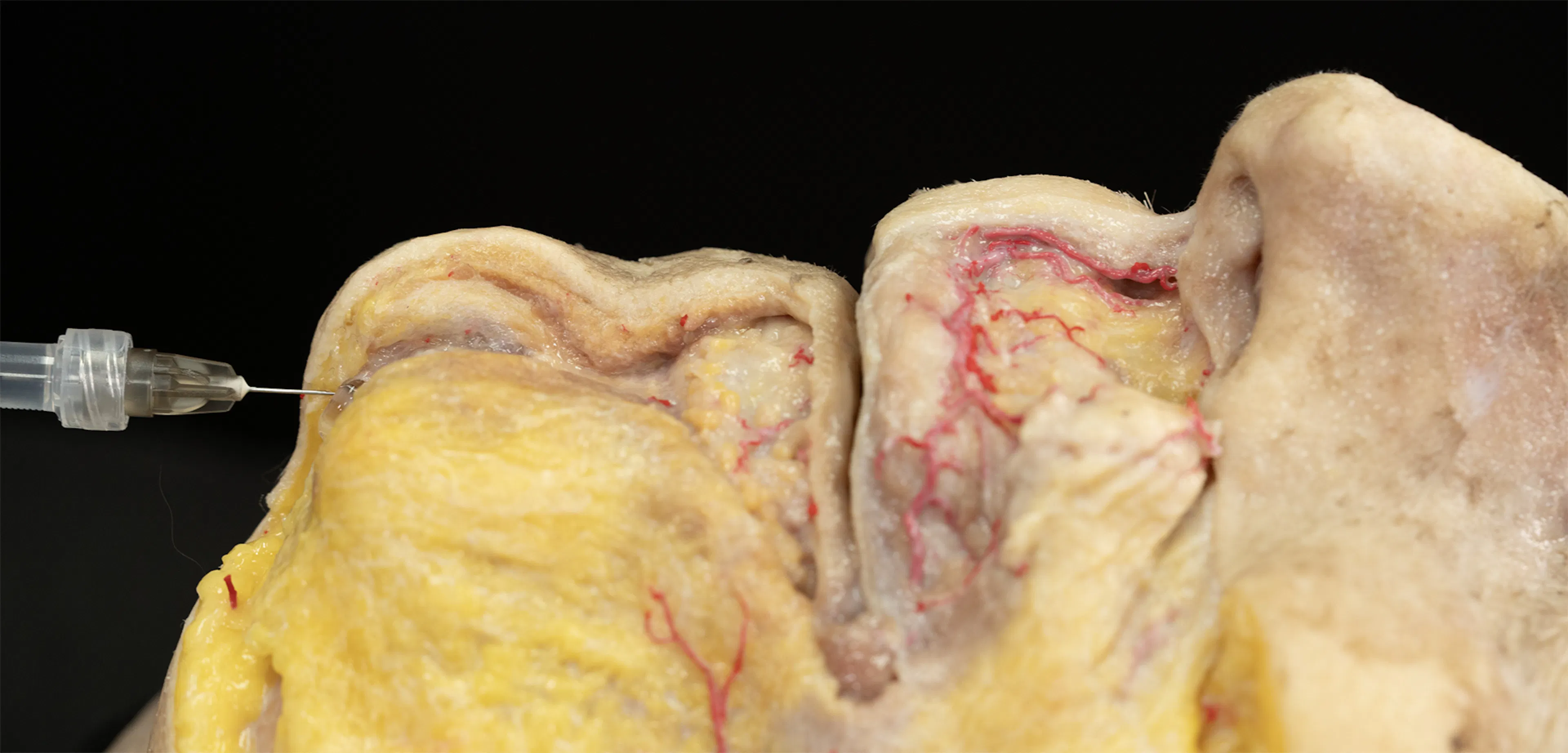 Chin Zone Treatment with Needle