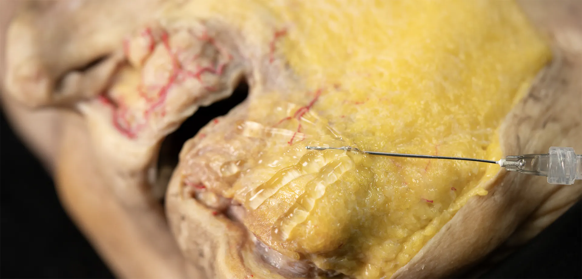 Chin Zone Treatment with Cannula