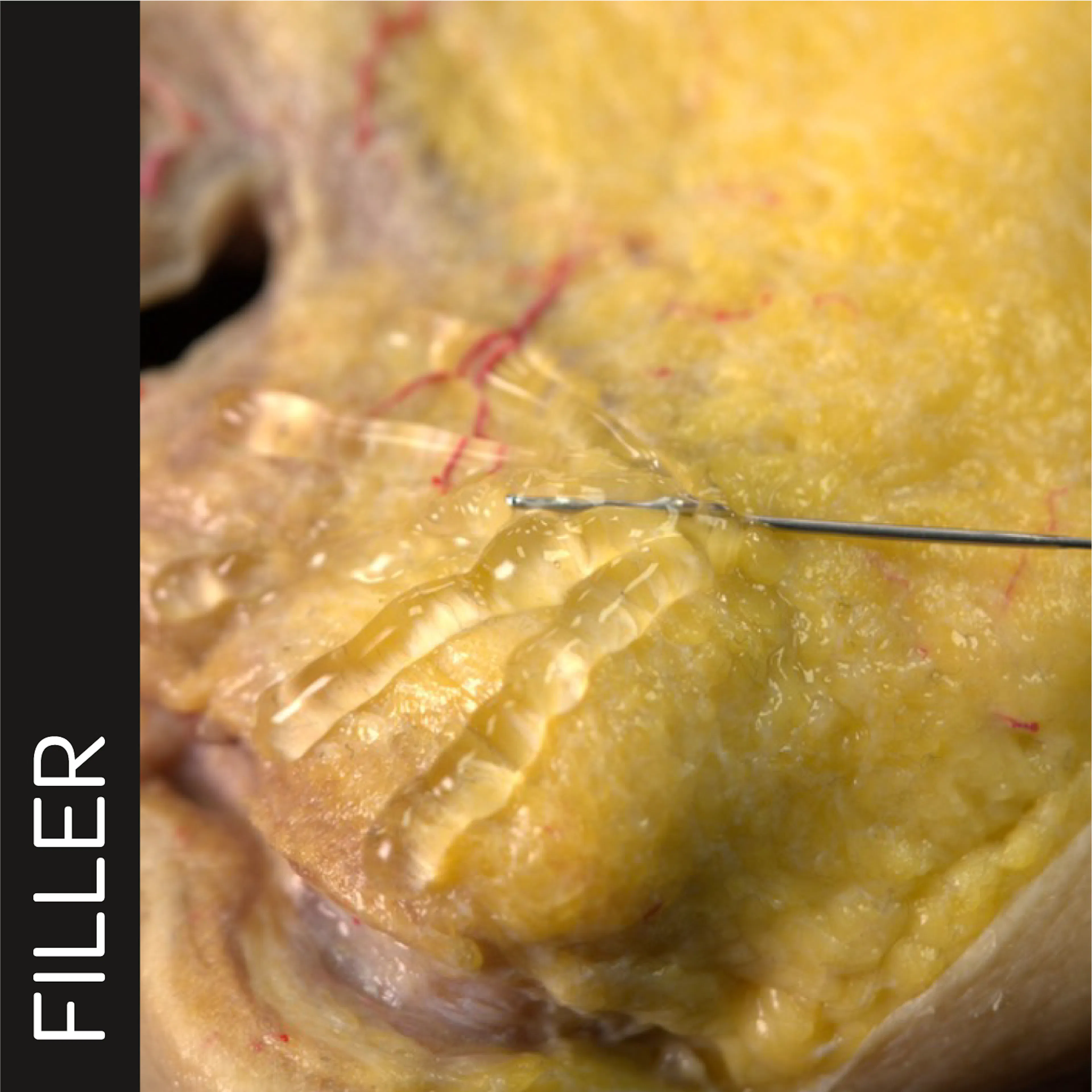 Chin Zone Treatment with Cannula treatment