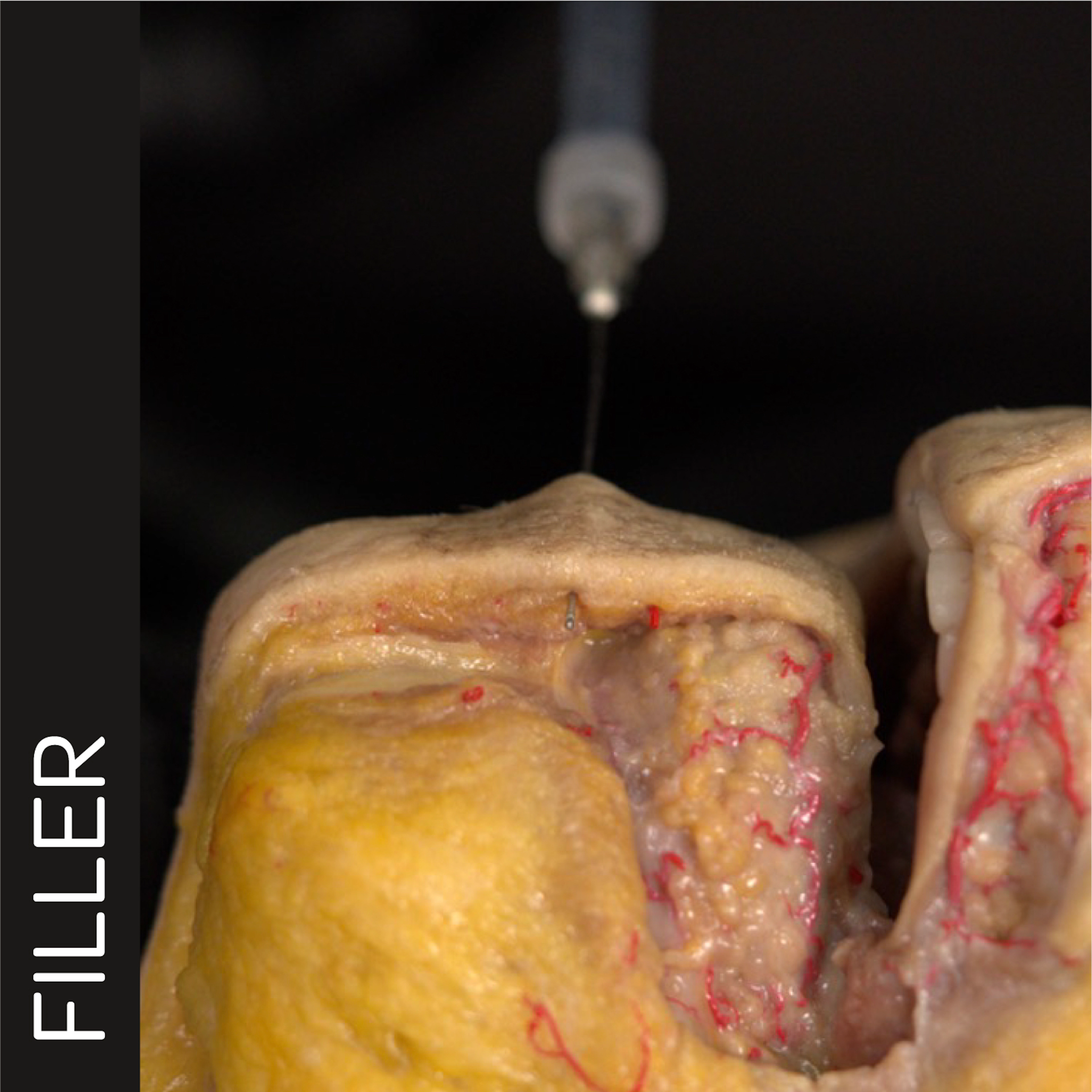 Labiomental Sulcus Smoothening (Needle and Cannula Techniques)