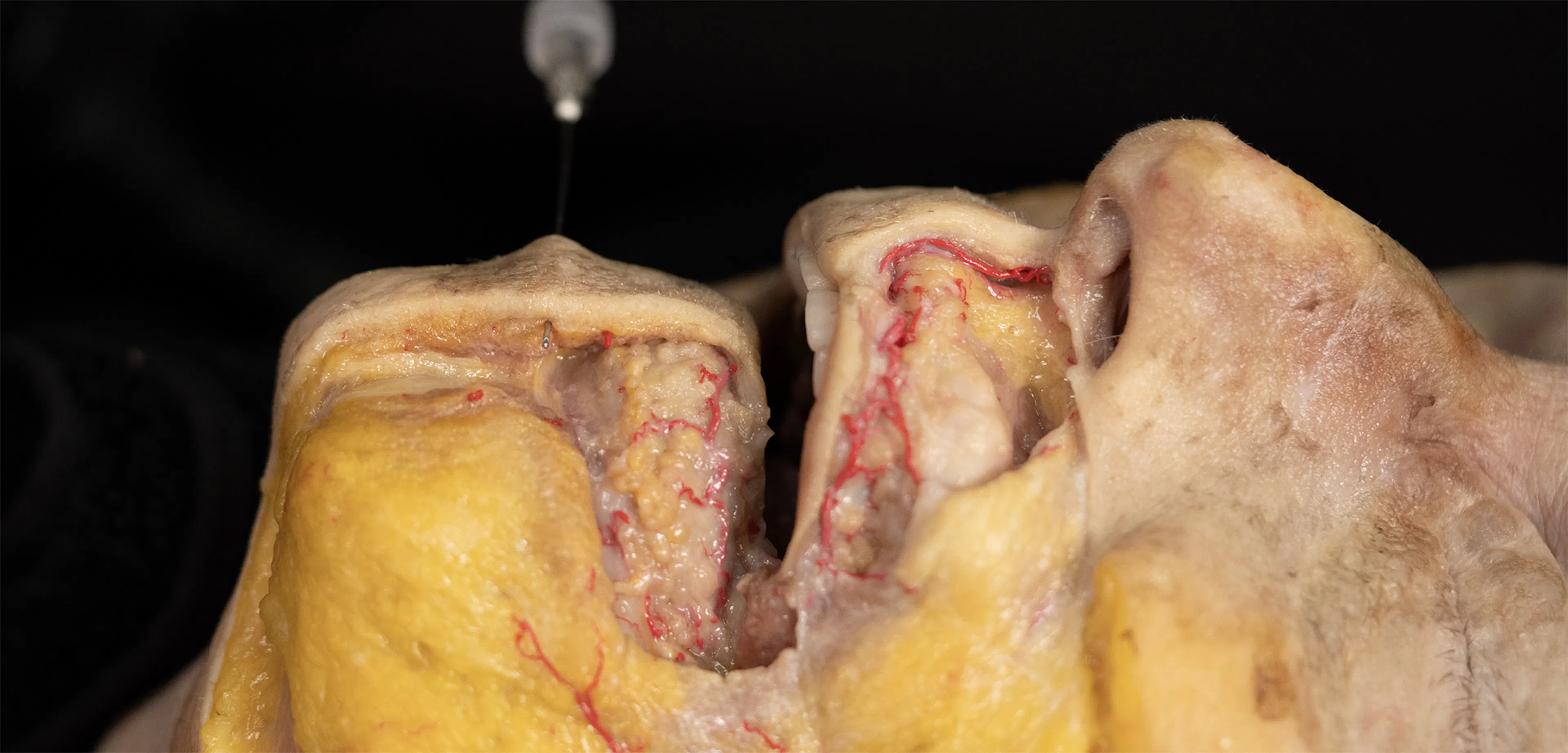 Labiomental Sulcus Smoothening (Needle and Cannula Techniques)