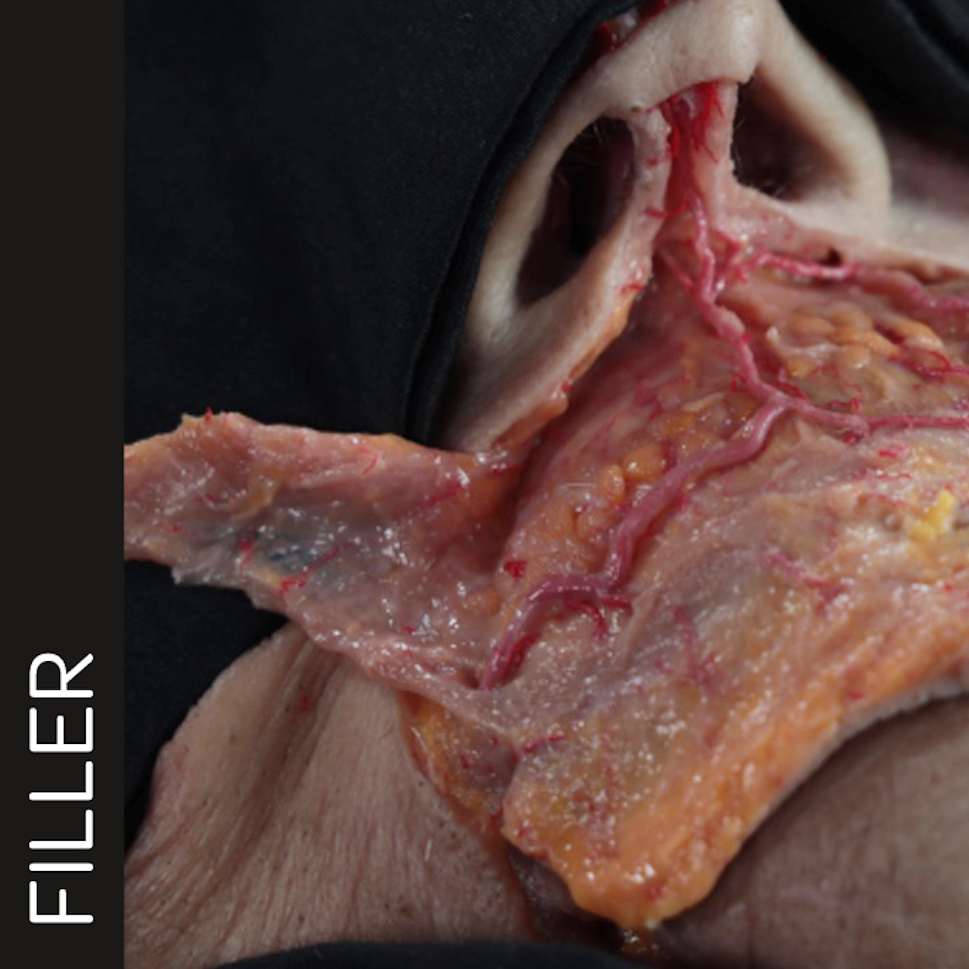 Close-up anatomical illustration of the perioral region with superficial skin layers lifted, exposing underlying lip structure, soft tissue planes, and key anatomical landmarks relevant to injection safety and treatment planning.