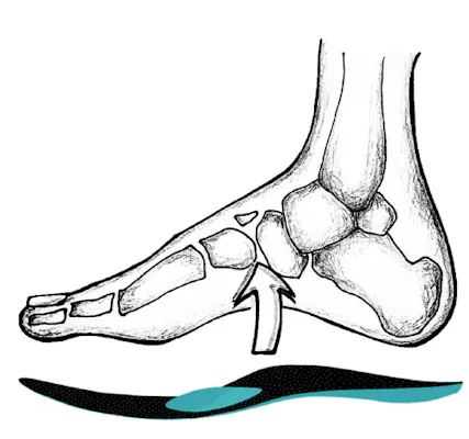 Skizze von Fuß mit Einlage