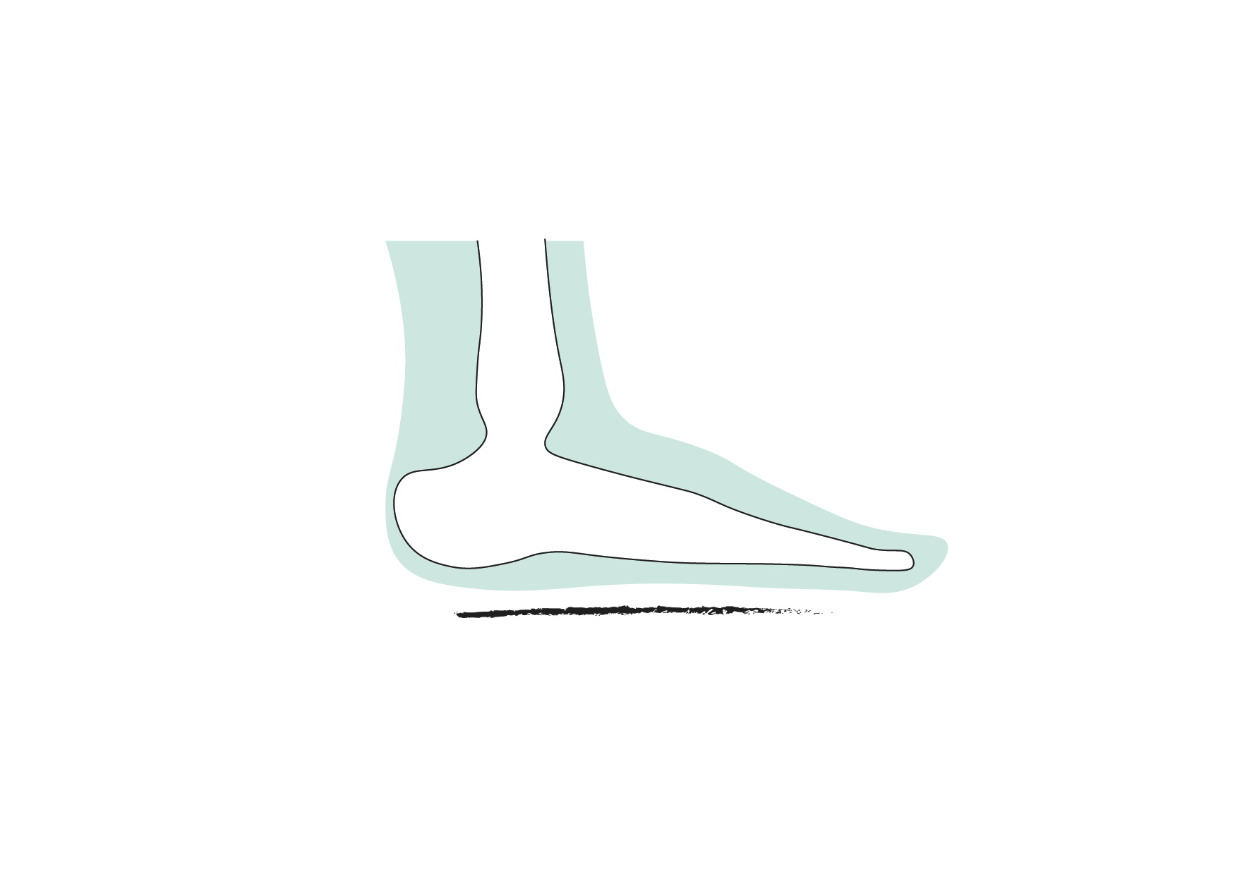 Plattfuß Fußfehlstellung