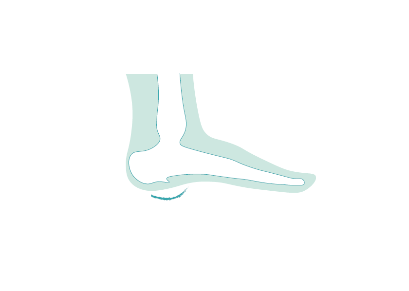 Fersensporn Fehlstellung