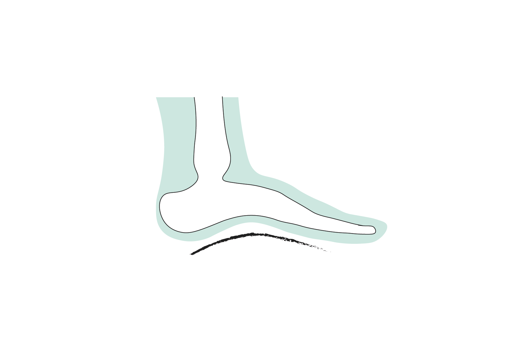 Fußfehlstellung Hohlfuß Einlagen
