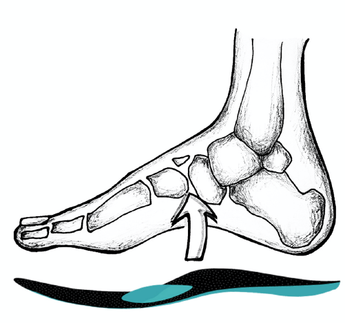 craftsoles Einlagen Fußfehlstellung