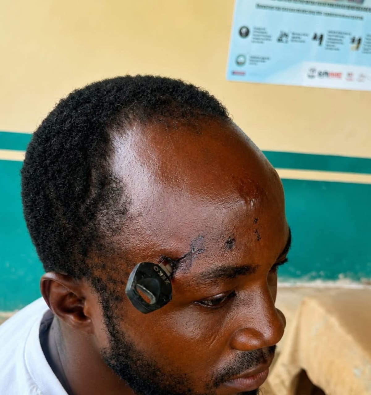 Farmer successfully undergoes treatment to remove key stuck in his skull