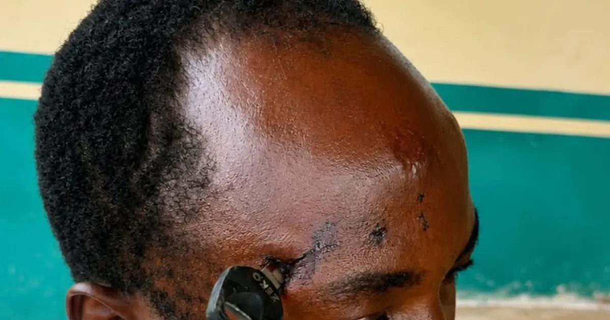 Farmer successfully undergoes treatment to remove key stuck in his skull