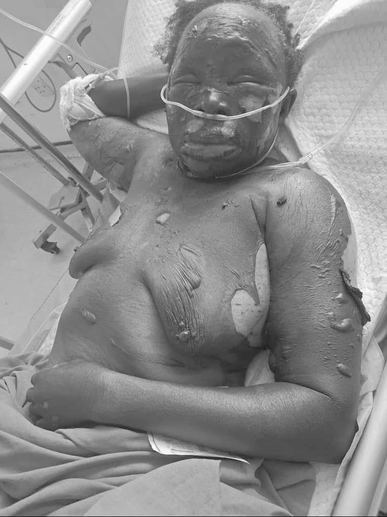 Man burns mother over marital issues