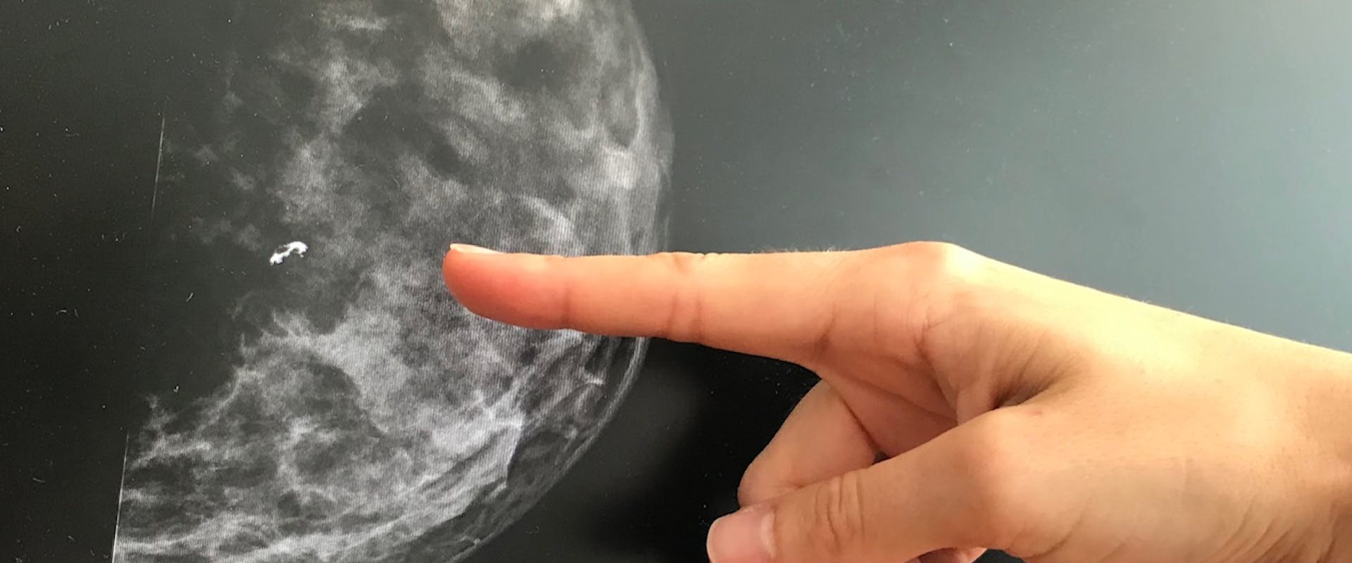 Interpretation of a mammogram by the radiologist