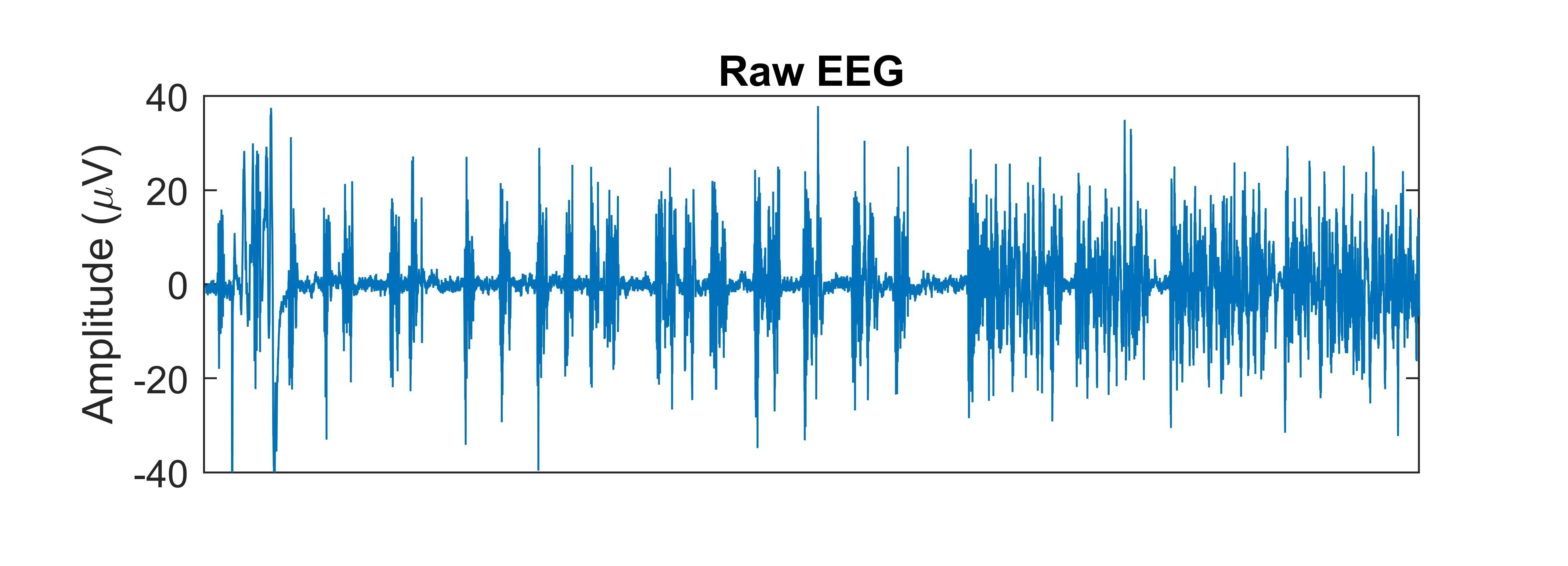 Tracé EEG en burst-suppression montrant des alternances des périodes d’onde de haute amplitude et des périodes plates de suppression. © Darren Hight 2025​