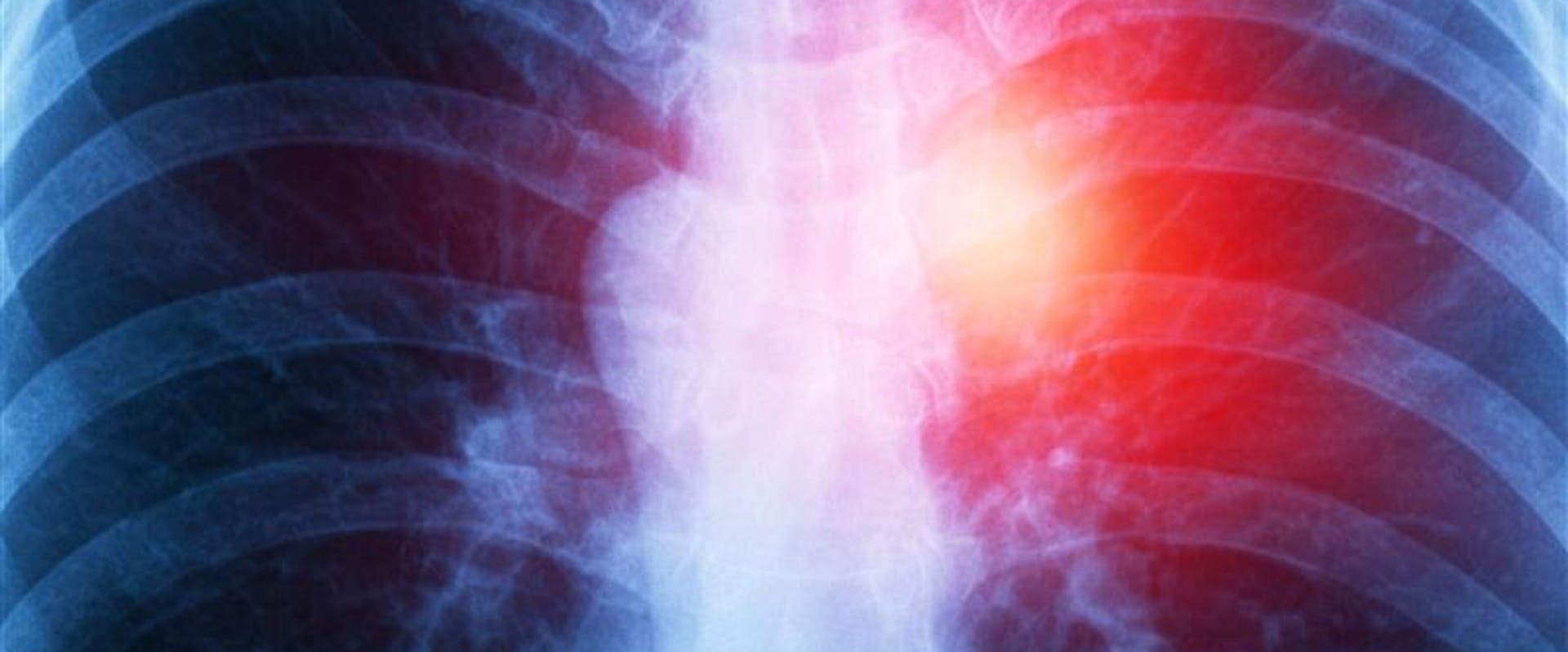 Chest X-ray showing a highlighted area in the right lung, suggesting a lung tumor.