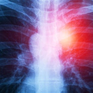 Chest X-ray showing a highlighted area in the right lung, suggesting a lung tumor.