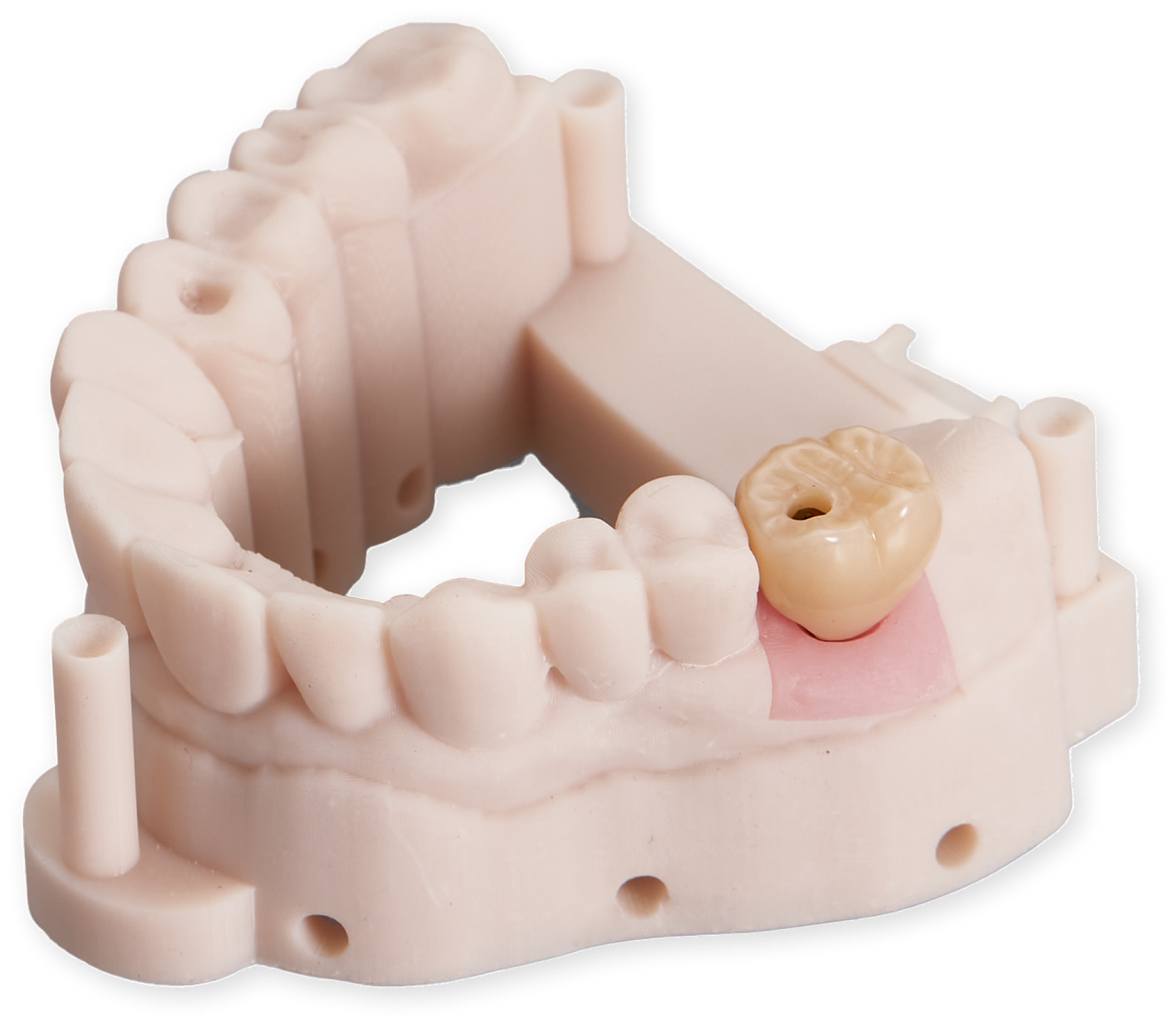 Implant restoration model