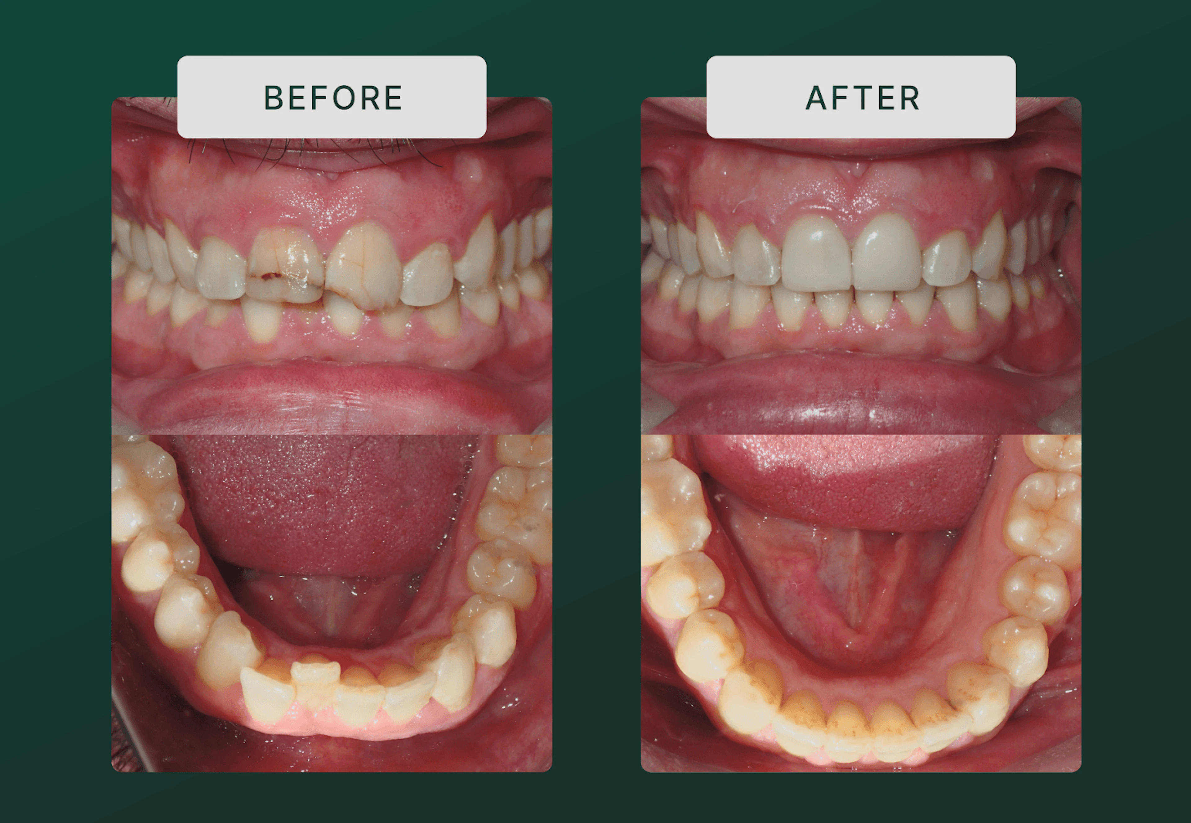 Precision-Driven Crown and Aligner Care