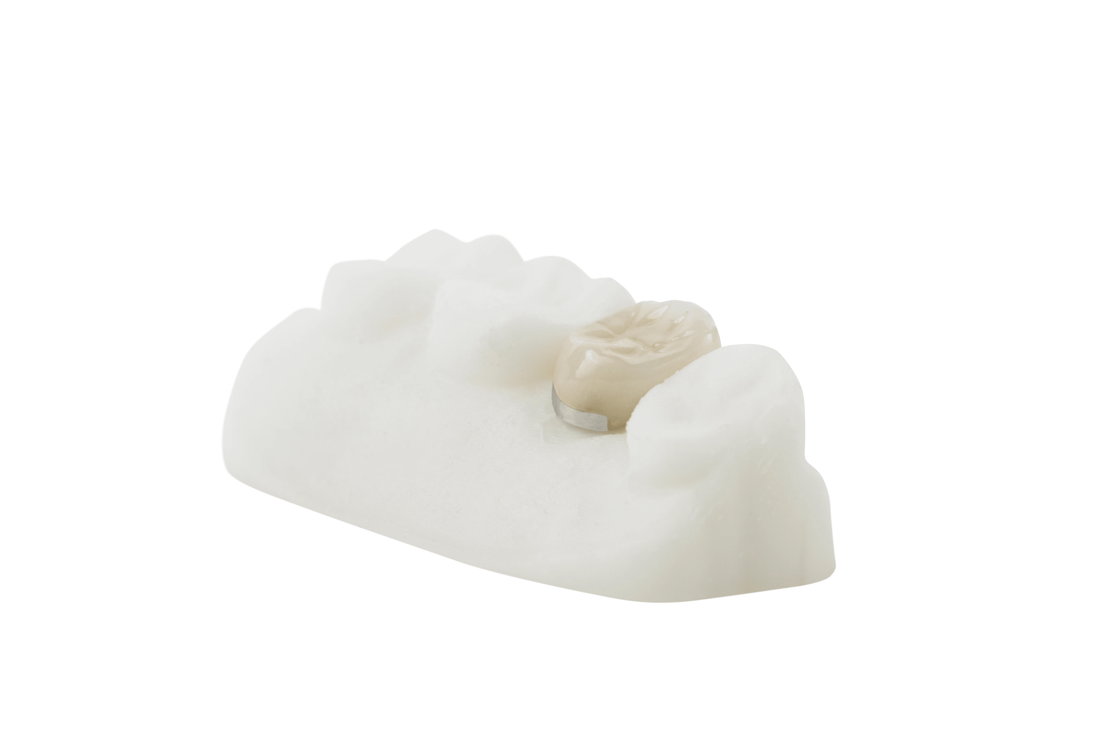 porcelain fused to metal crown