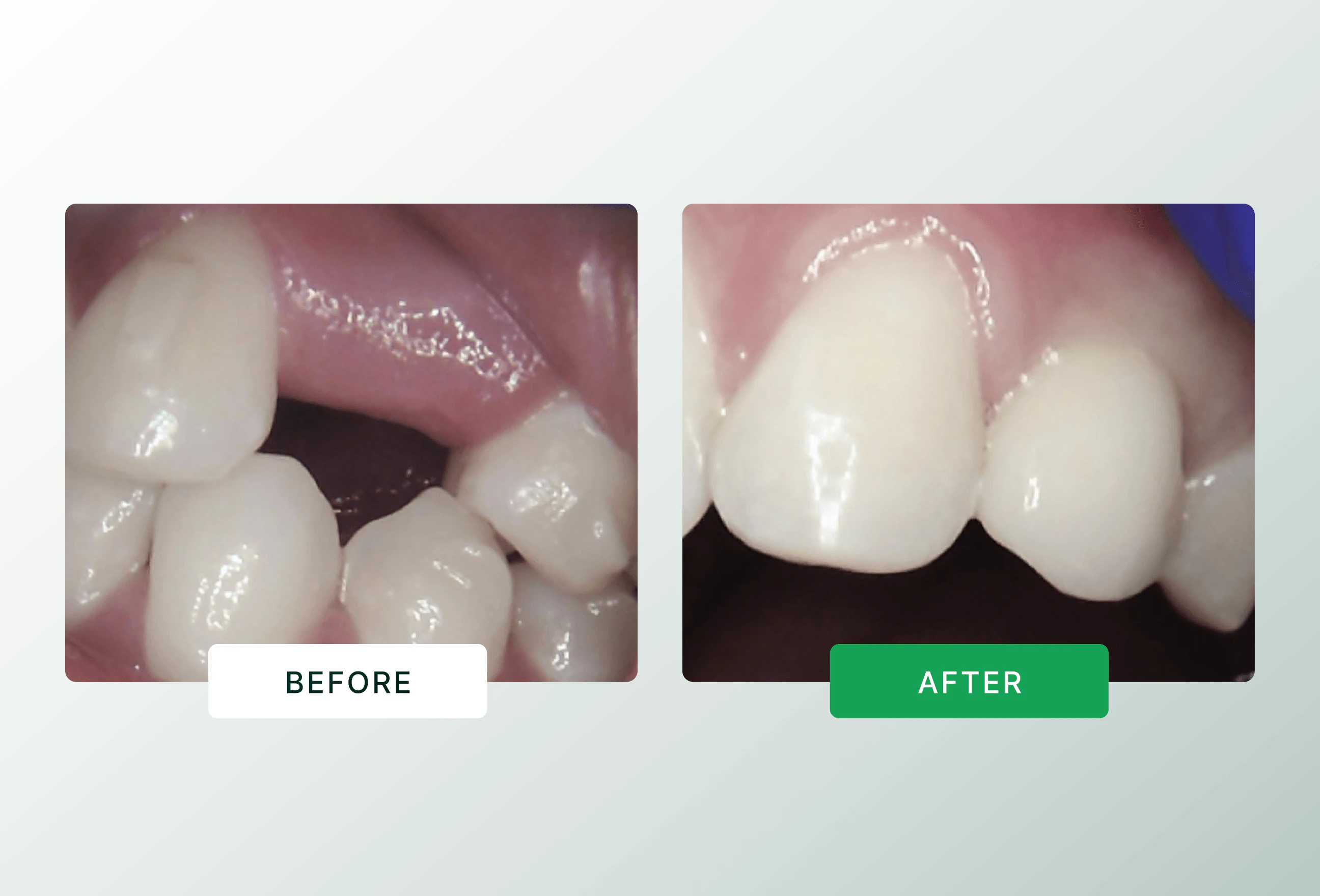 Anterior implant before and after comparison