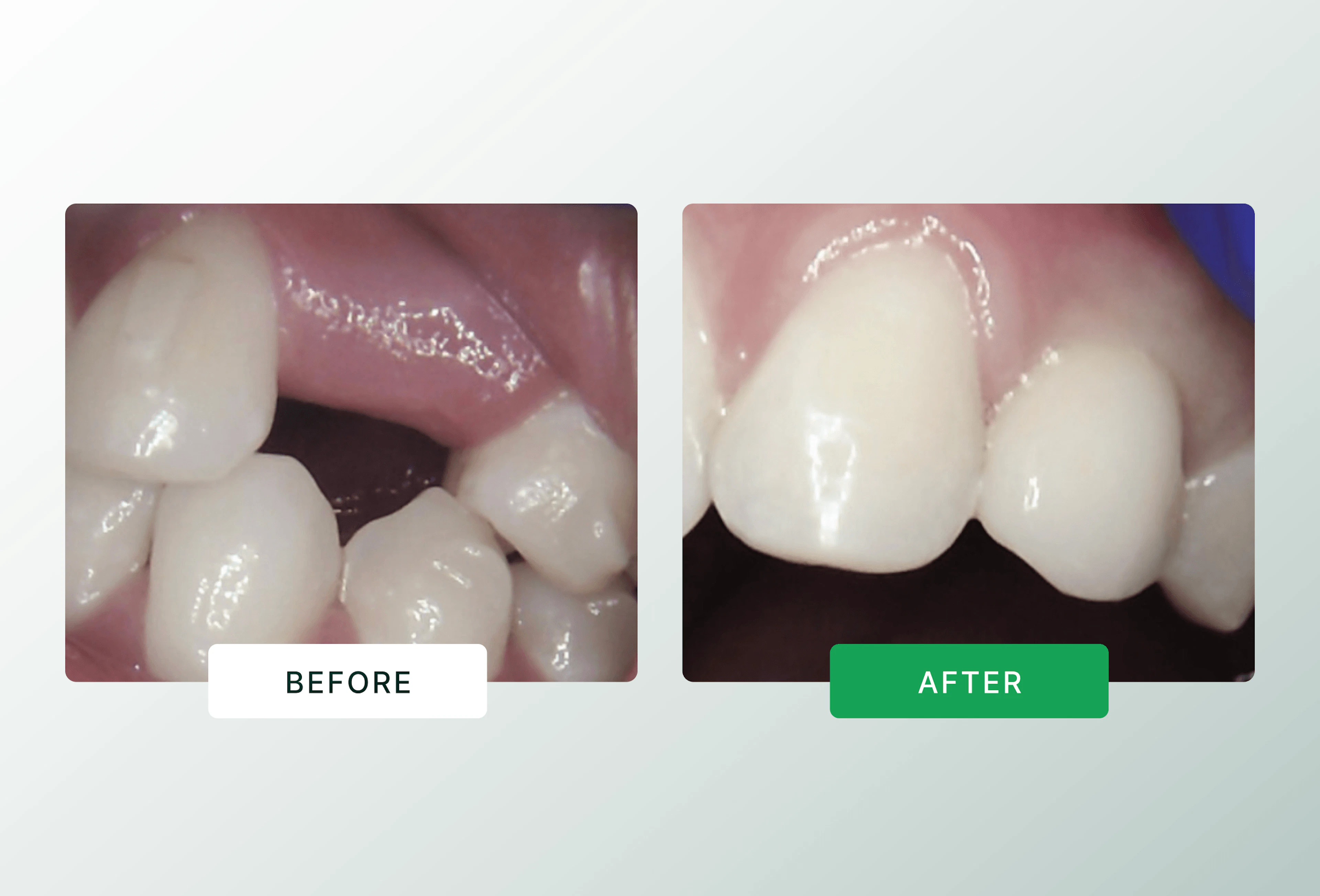Anterior implant before and after comparison