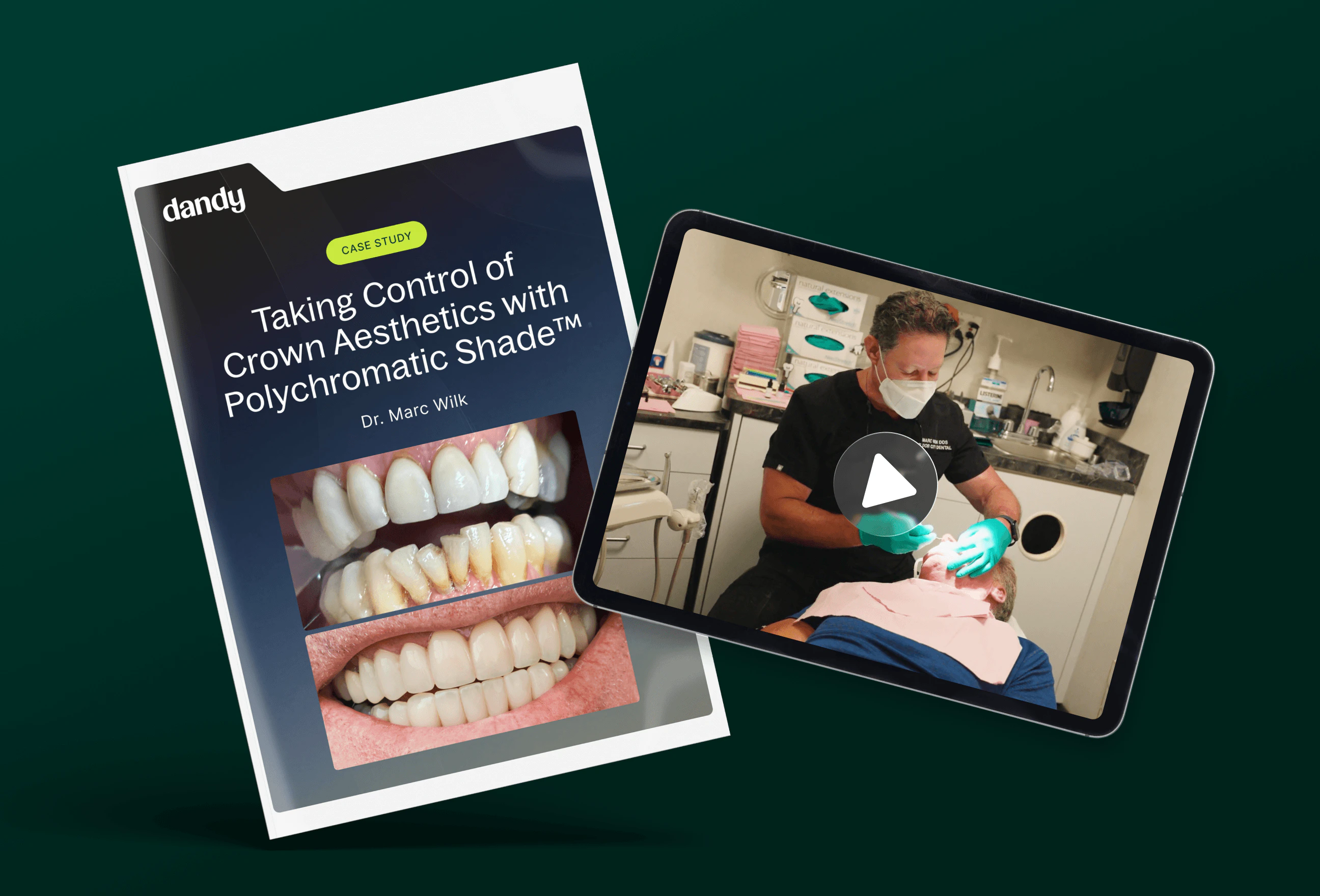 Taking Control of Crown Aesthetics with Polychromatic Shade cover