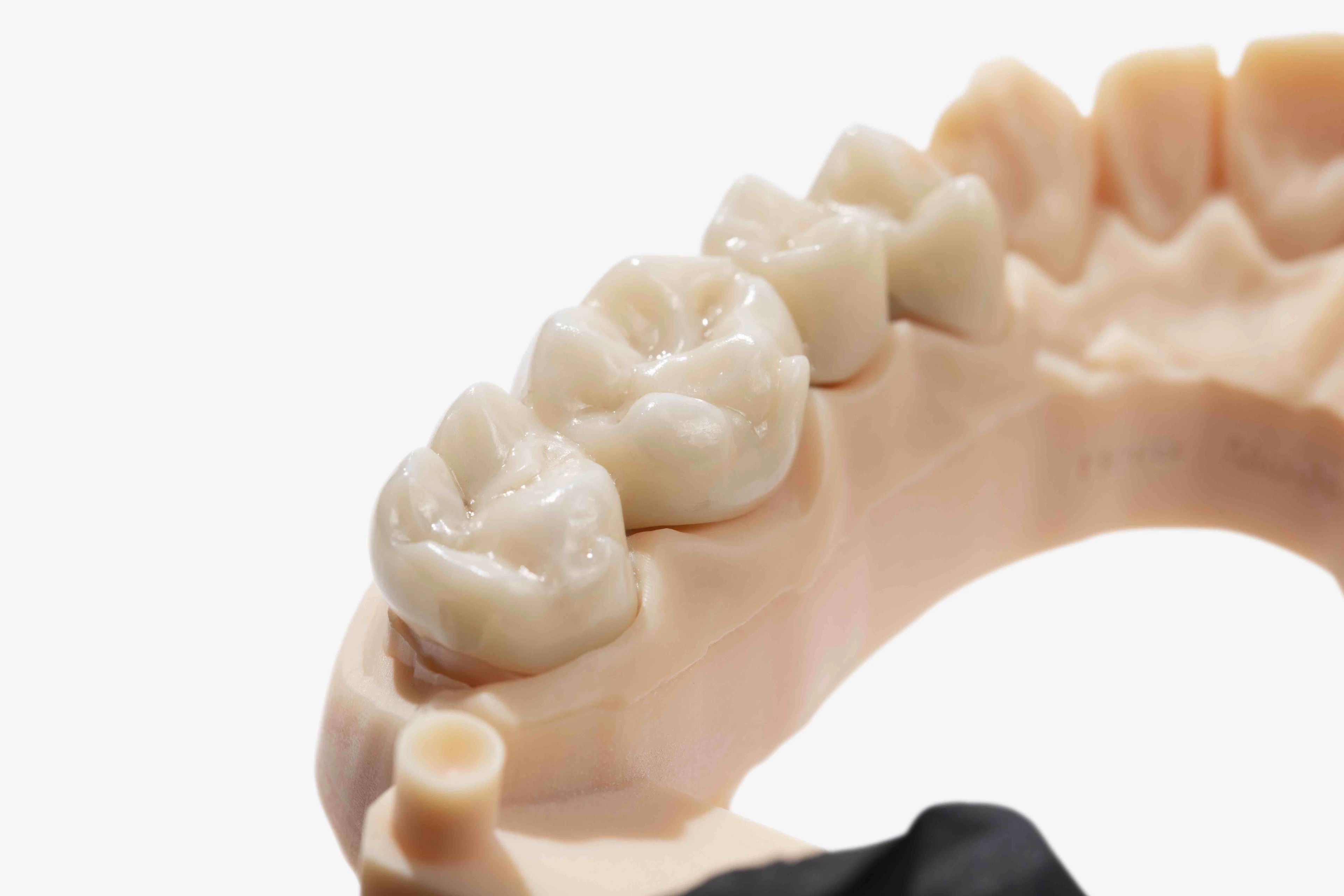 Zirconia Bridge