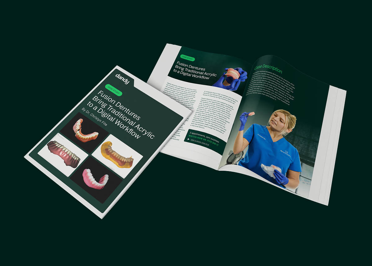 Fusion Dentures Bring Traditional Acrylic to a Digital Workflow thumbnail