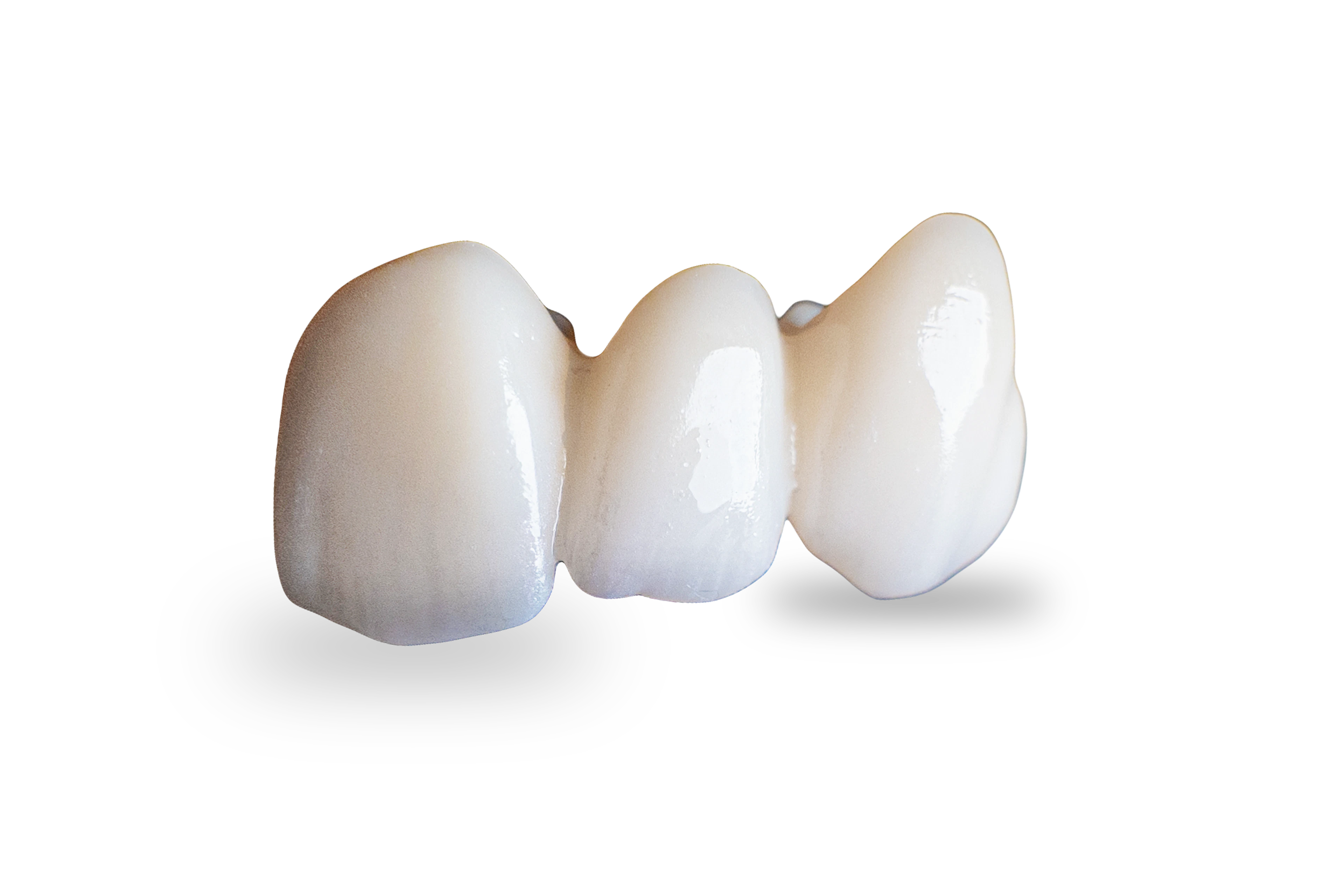 Dental crown restoration