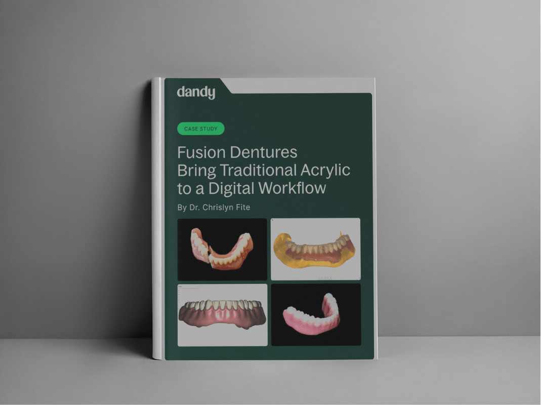 Case Study Full Dentures - Fusion Dentures Bring Traditional Acrylic to a Digital Workflow