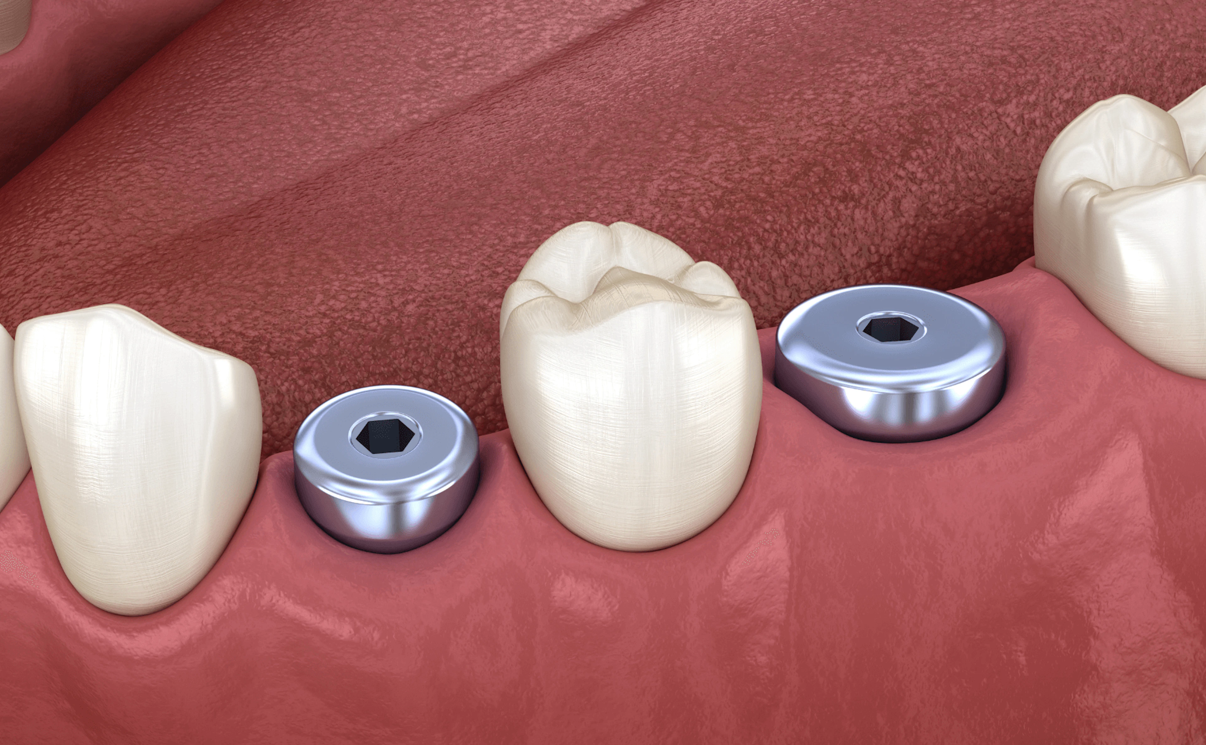 3D imagery of an implant healing abutment