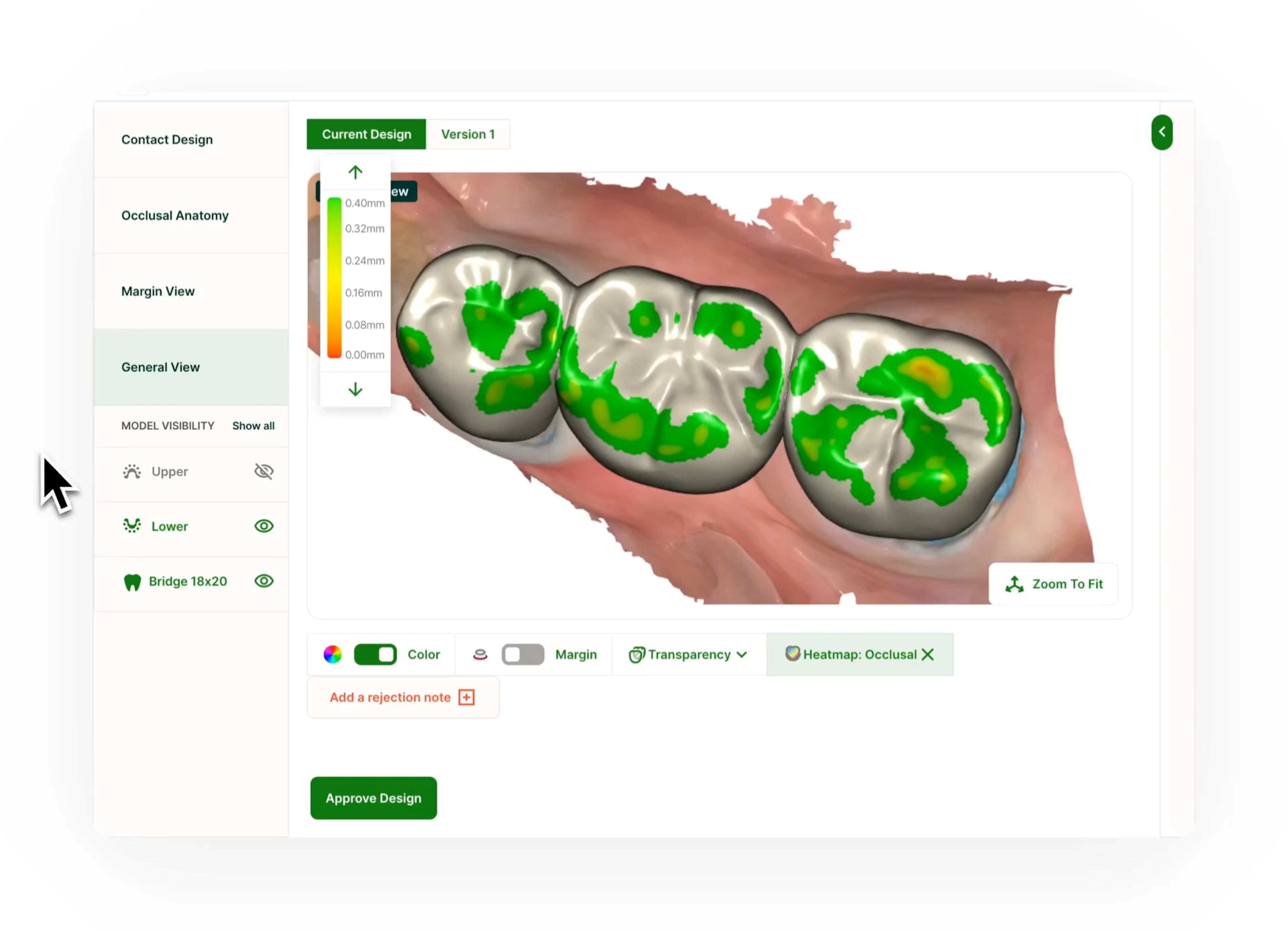 3D case design review tool showing an occlusal clearance heatmap