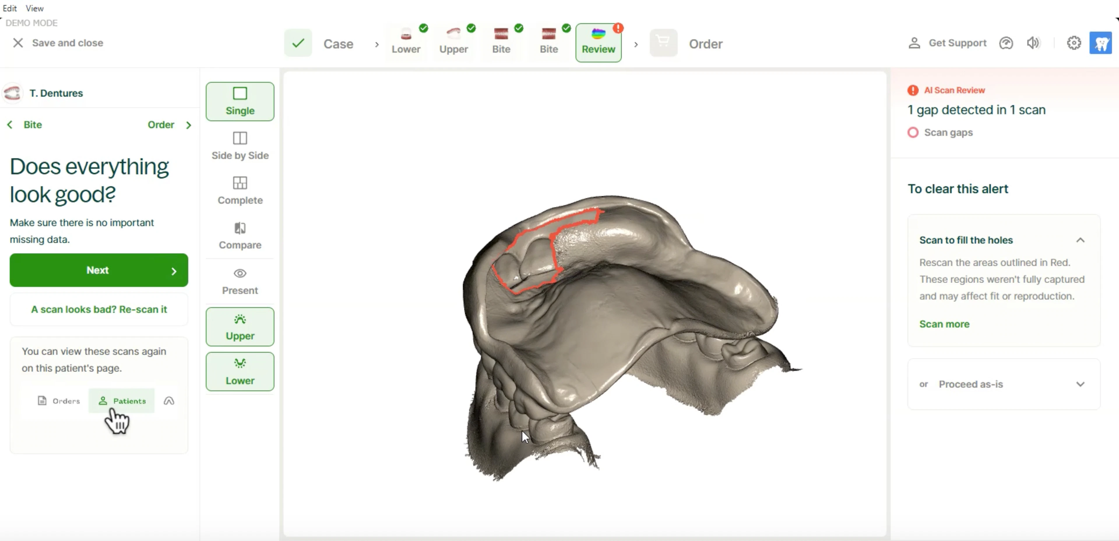 Chairside denture AI scan detected