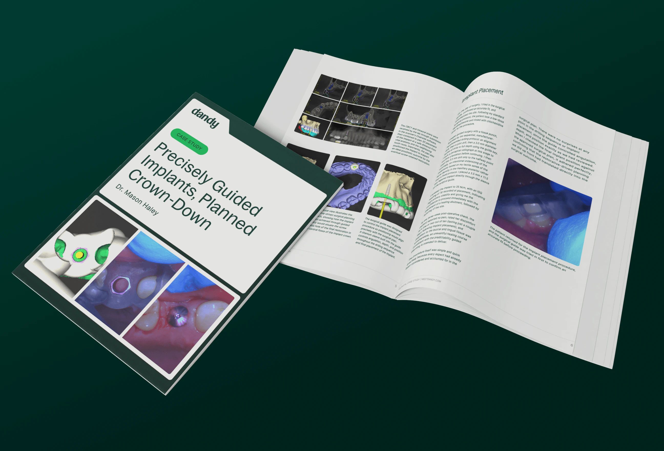 Surgical guides case study by dr. Mason Haley and Dandy