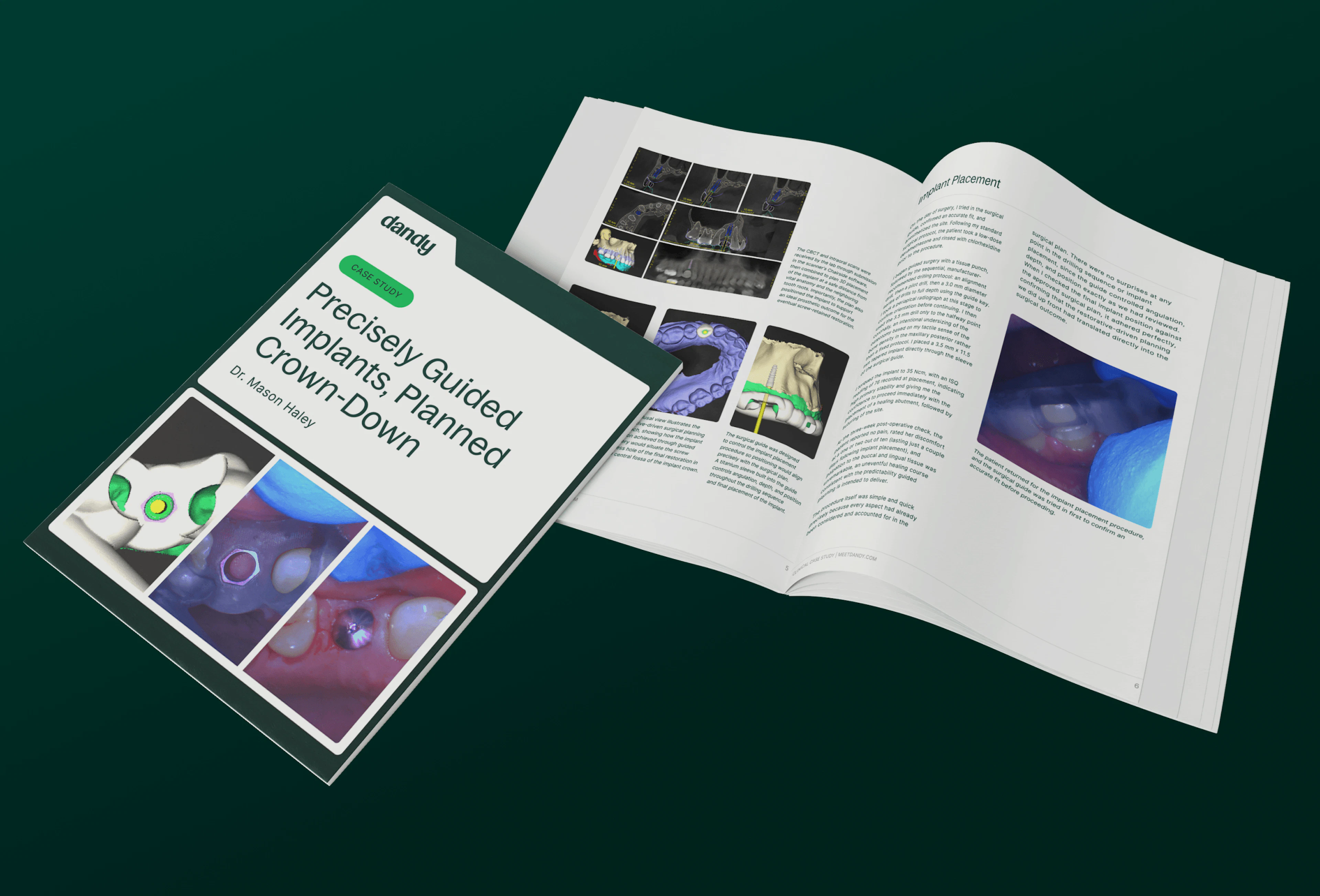 Surgical guides case study by dr. Mason Haley and Dandy